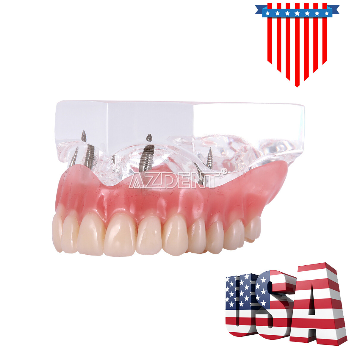 Dental Implant Teeth Model Demo Overdenture Restoration With Implants Lower 6003