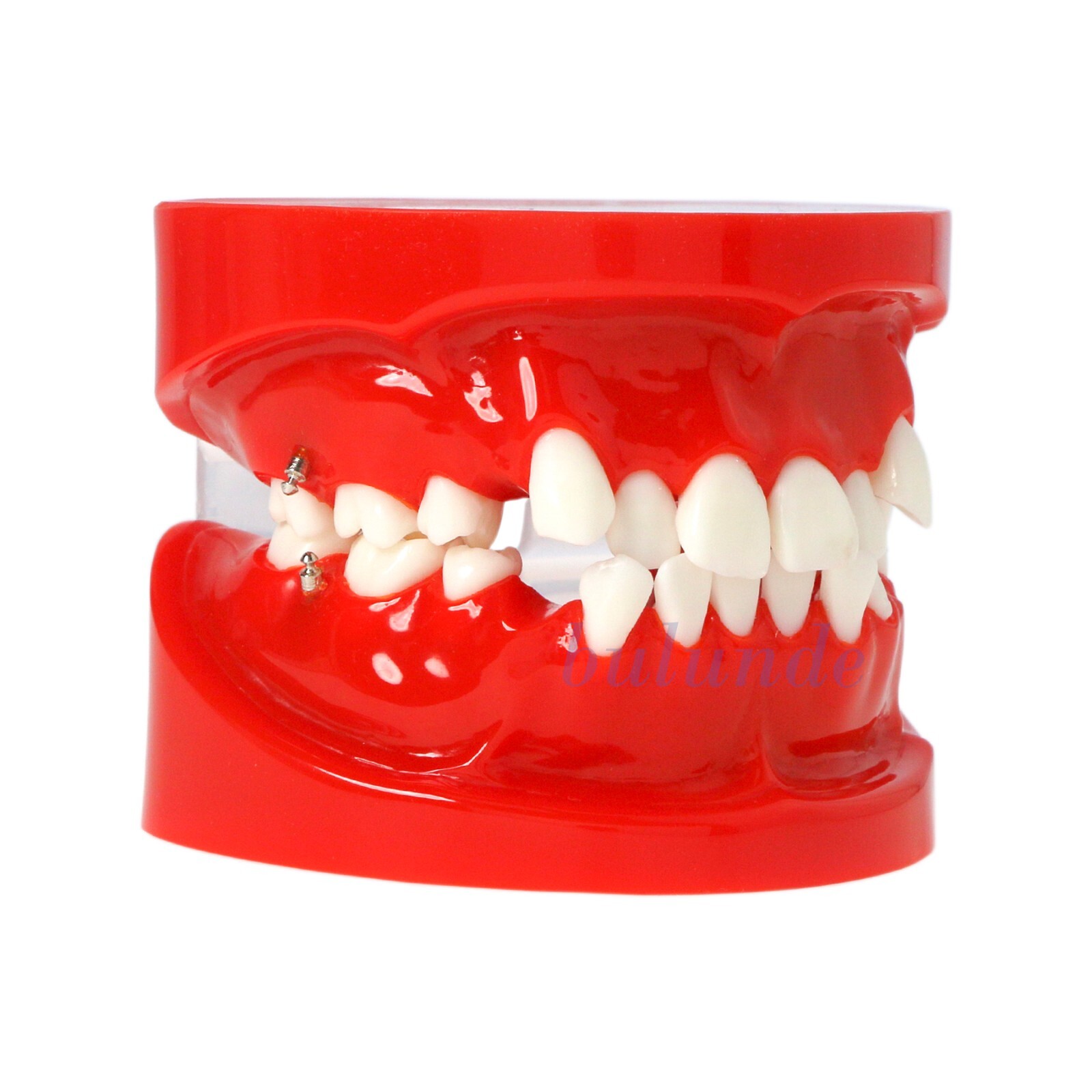Dental Typodont Teeth Model Implant Pathological Perio Restoration Practice Demo