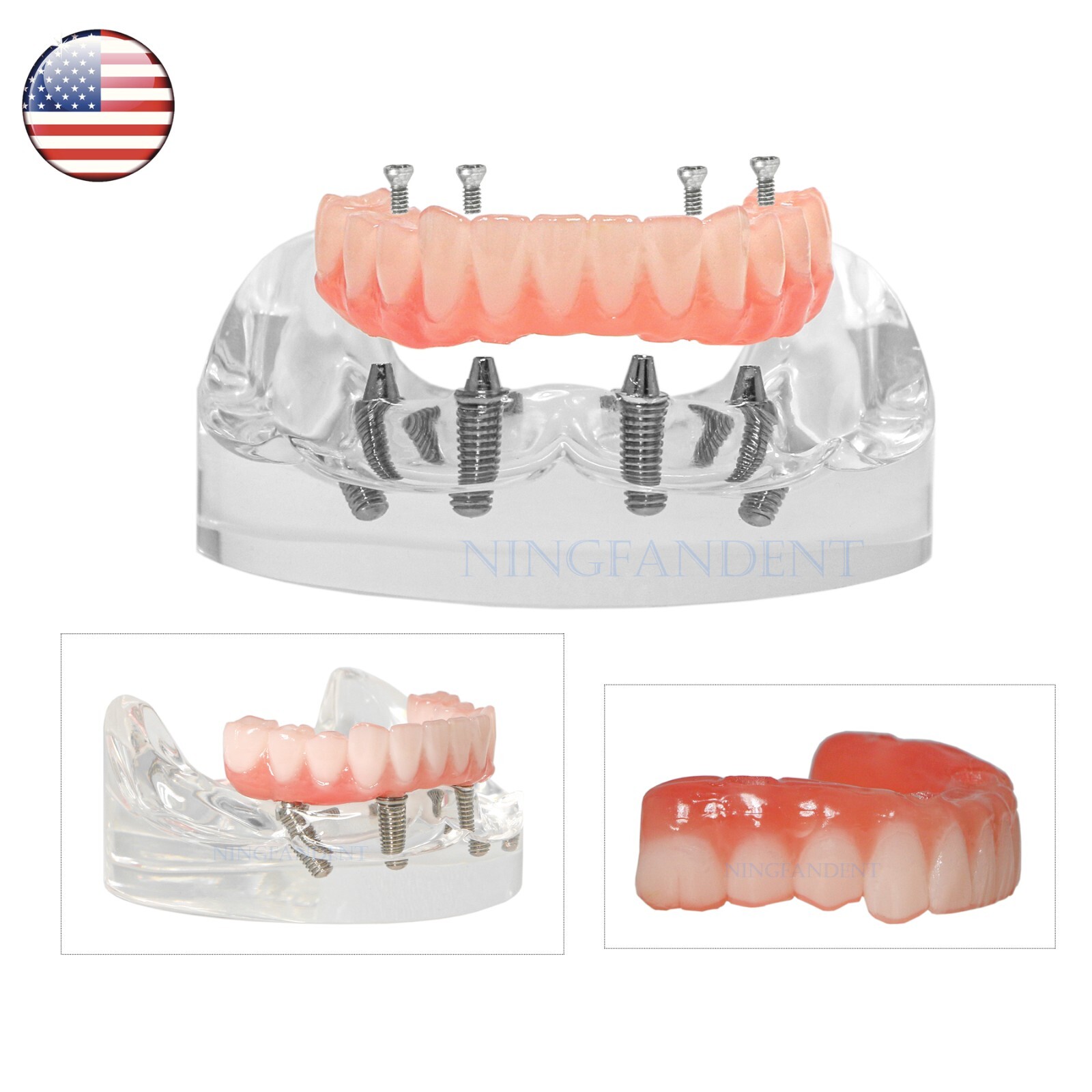 Dental All-on-4 Overdenture Implant Model, Upper/Lower Jaw-Clear,With 4 Screw