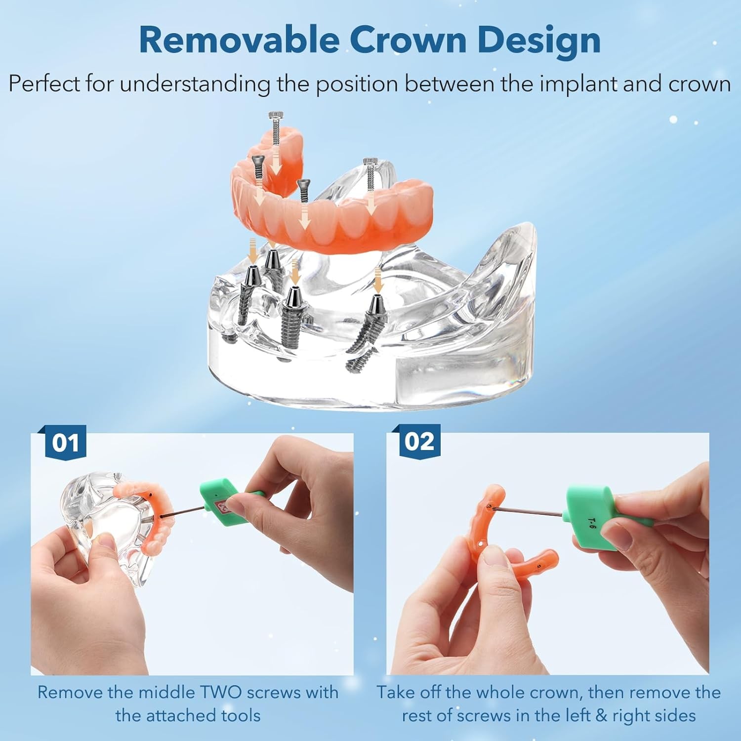 US Dental Overdenture Implant Model All-on-4 With 4 Screw Upper/Lower Clear Jaw