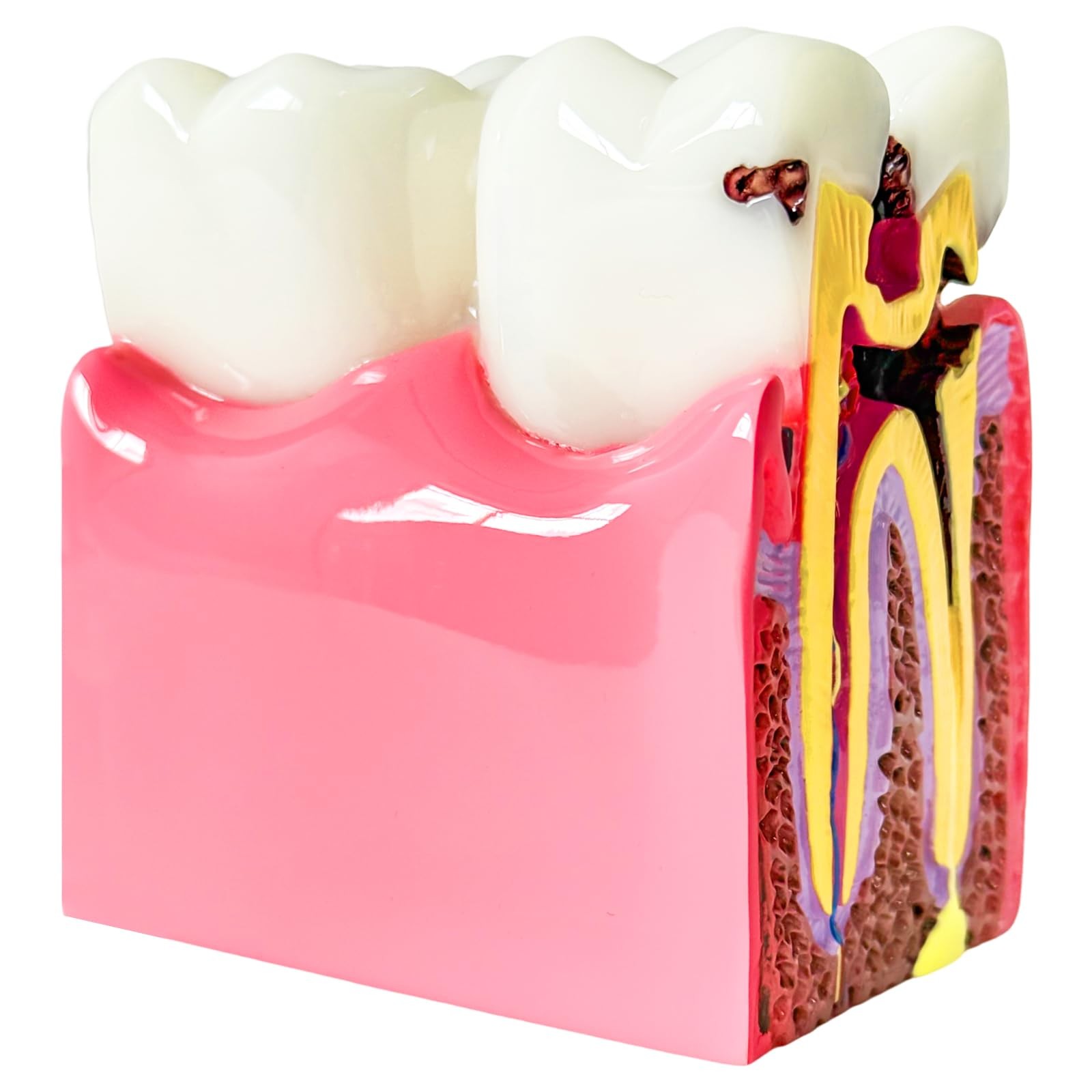 Dental Caries Teeth Model, 3.4 x 3 x 2 Inches – 6 Times Enlarged Dental…