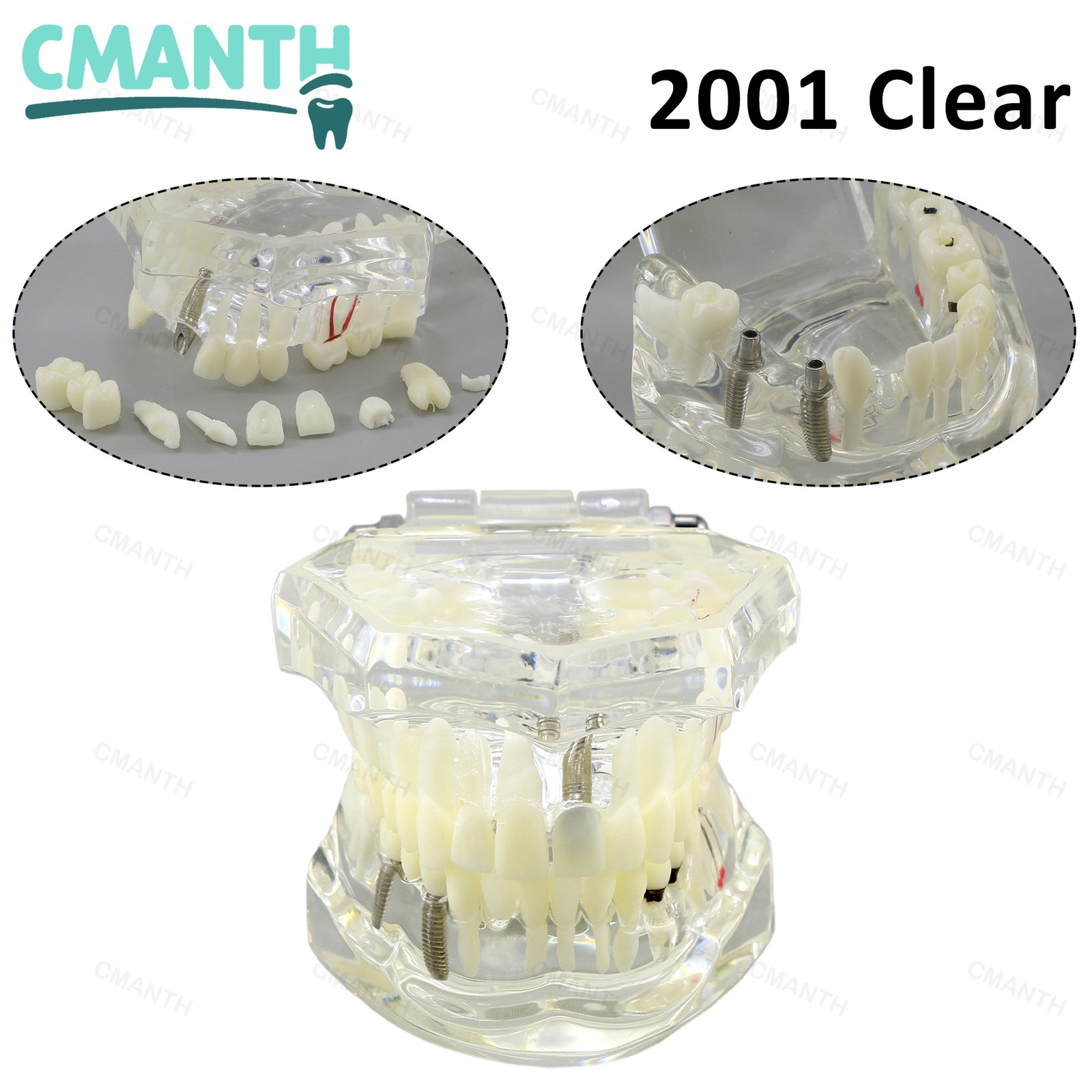 US Multiple Types Dental Model Orthodontic Removable Teeth Implant Models Tools
