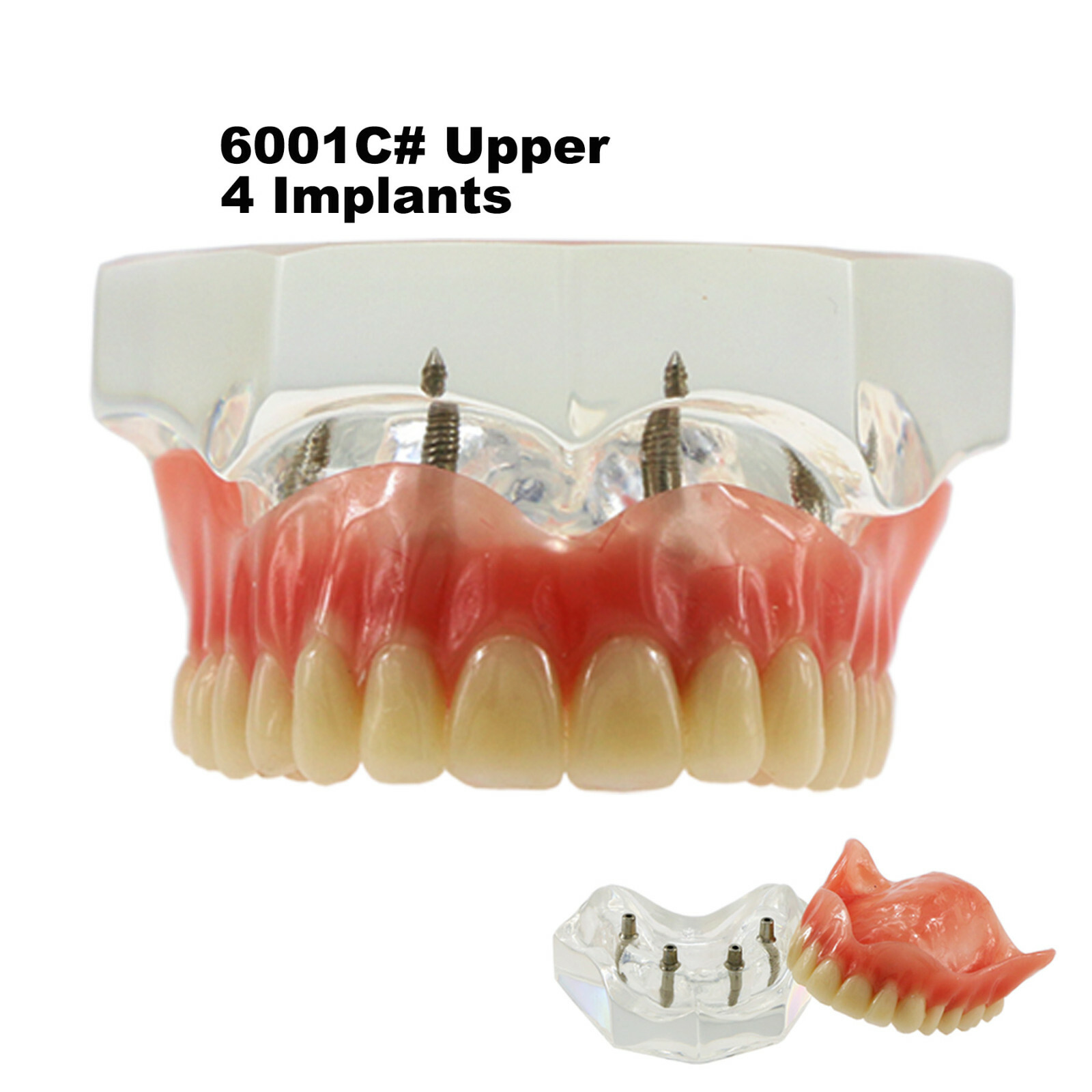 Dental Teeth Model 2 4 Implant Overdenture Typodont Restoration Demo Upper Lower