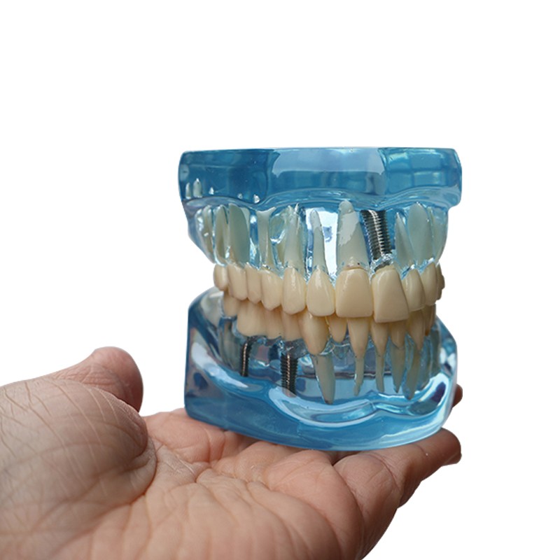 Dental Teeth Model Ortho Implant Practice Teaching With Implants Demo Model