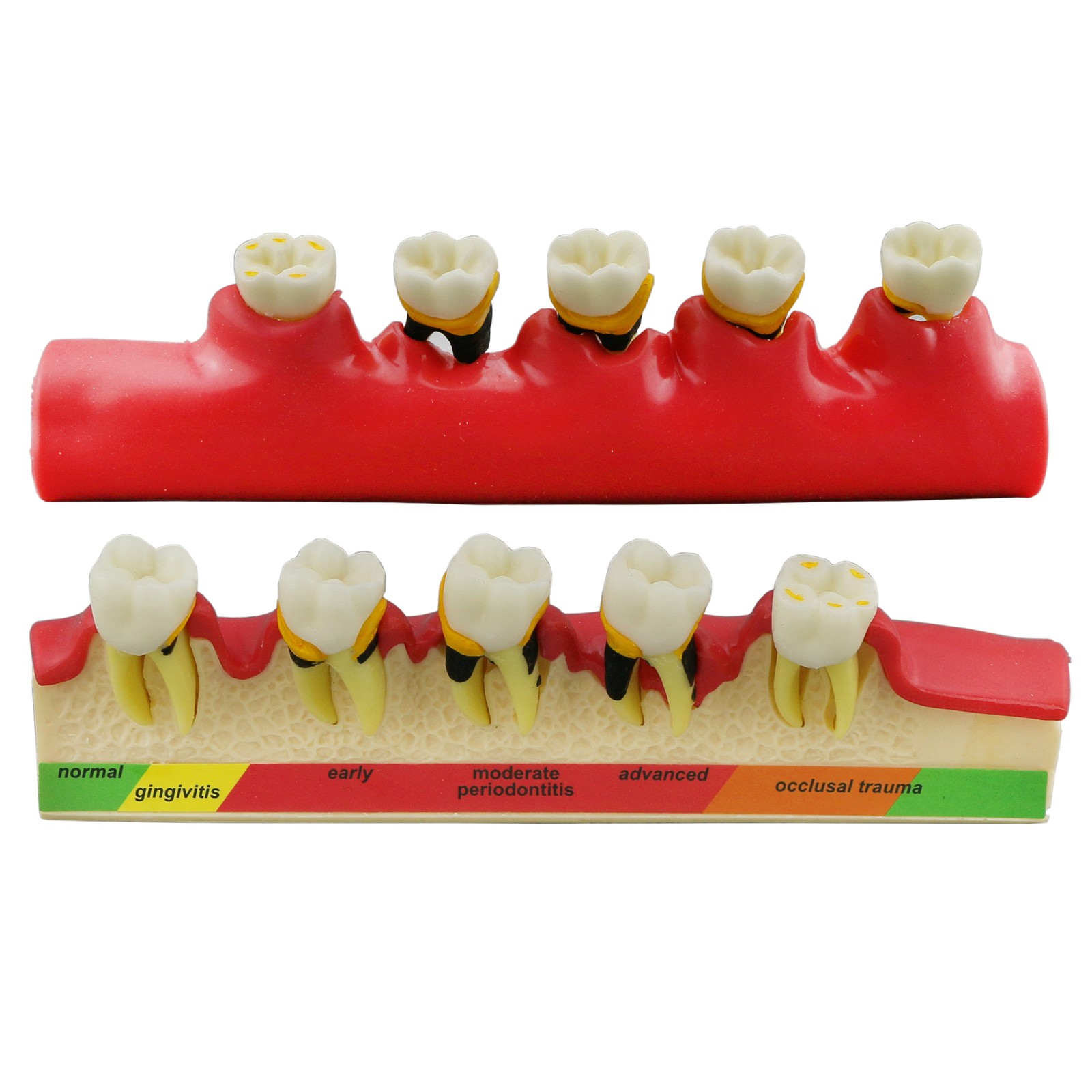 Dental Pathological Model 5 Stage Periodontal Disease Patient Communication Demo