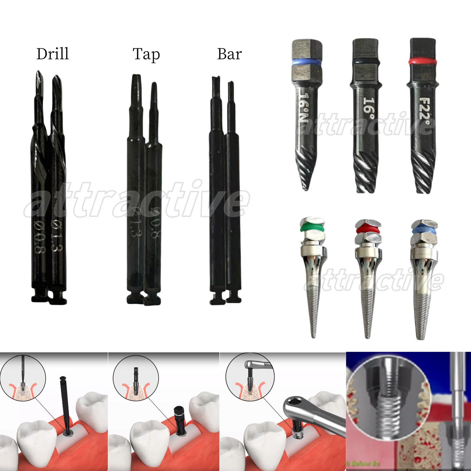 Dental Fixture Fractured Broken Screws Failed Implant Extractor Screw Remover