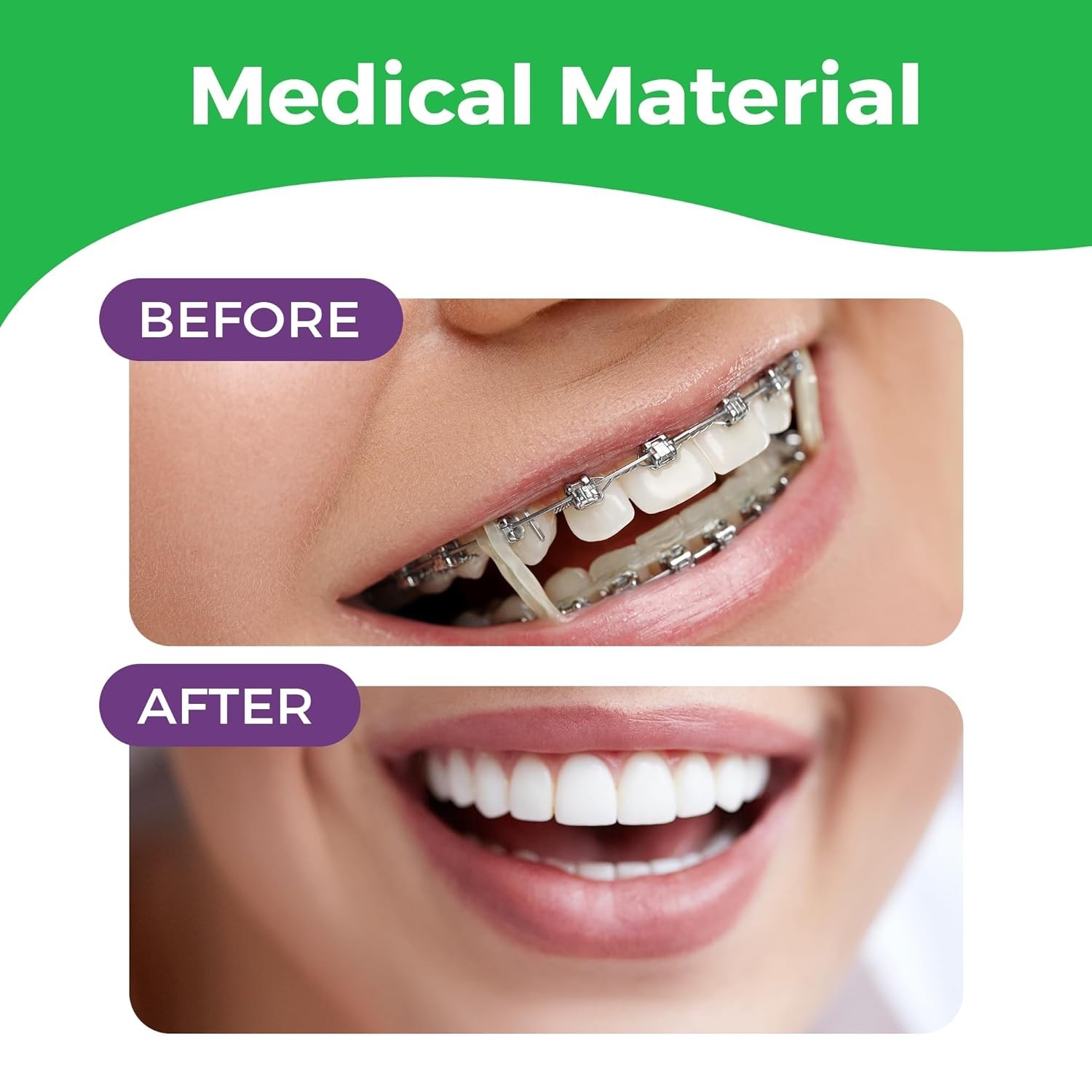 Versatile 100-Pack Neon Orthodontic Rubber Bands with Free Elastic Placer