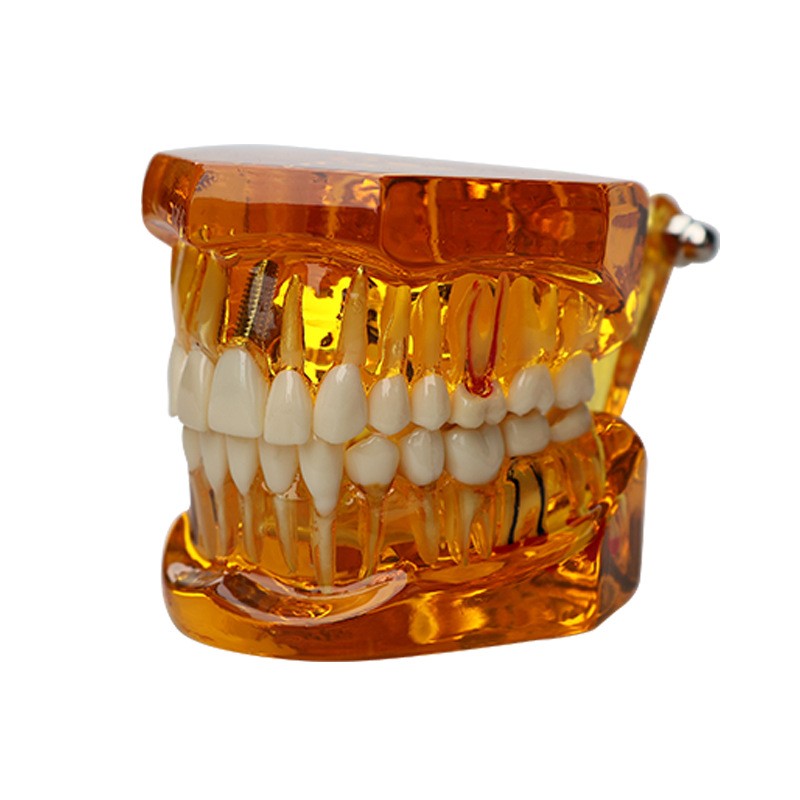 Dental Teeth Model Ortho Implant Practice Teaching With Implants Demo Model