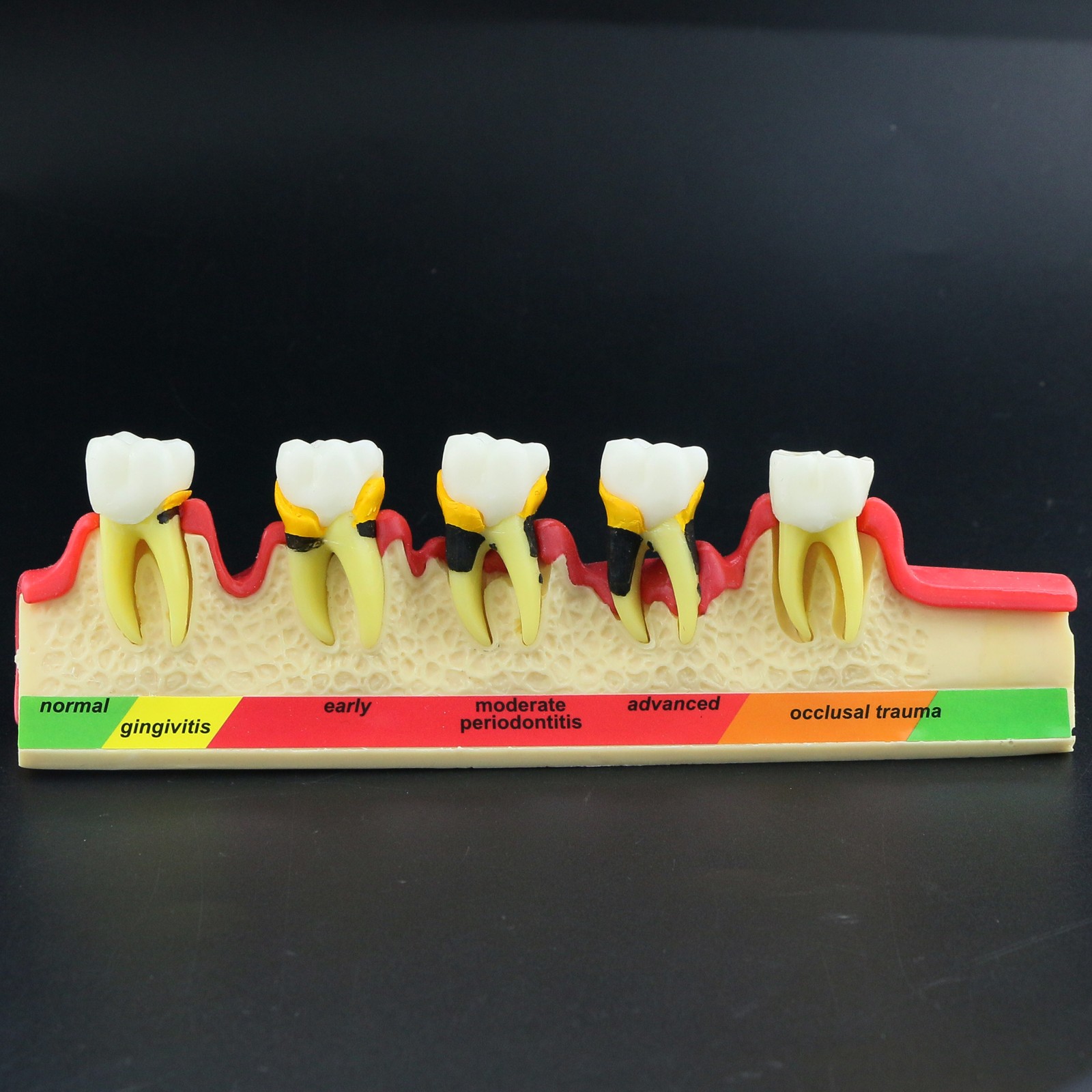 Dental Pathological Model 5 Stage Periodontal Disease Patient Communication Demo