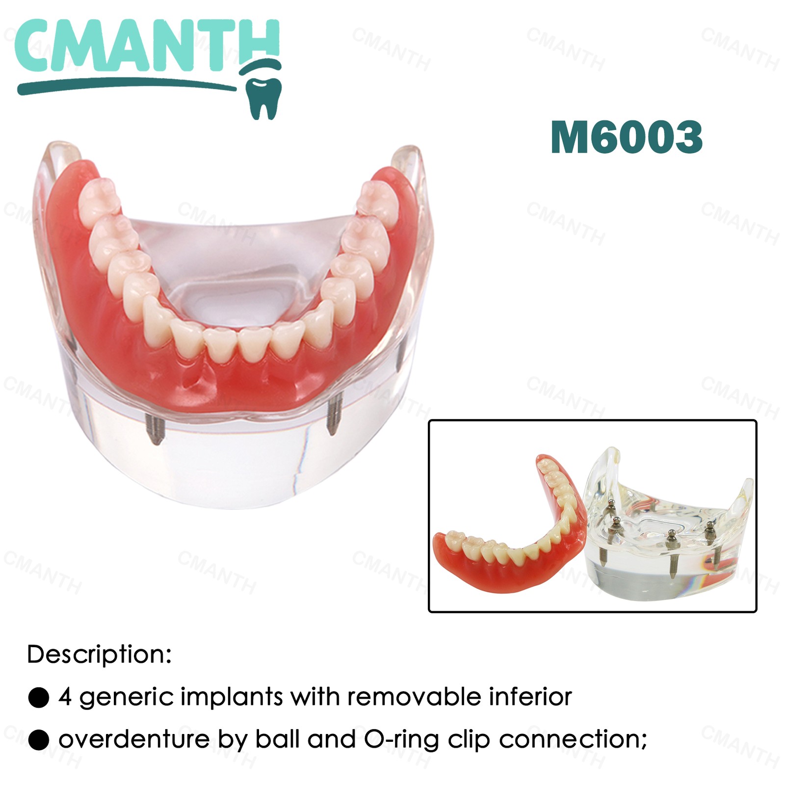 US Dental Model Clear Upper Lower 4 Implants Overdenture Restoration Removable