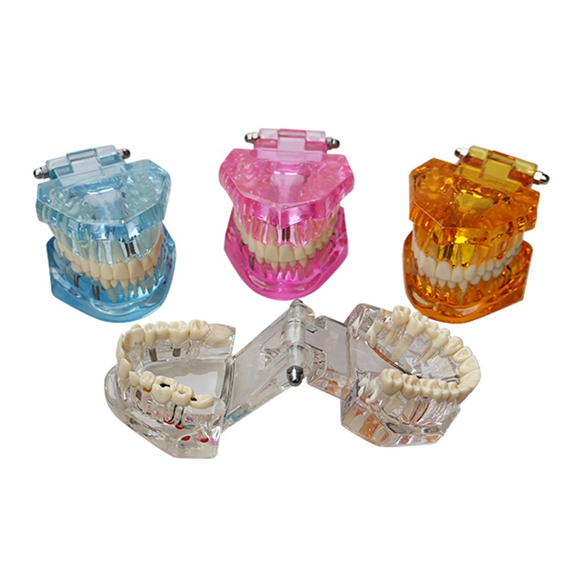 Dental Teeth Model Ortho Implant Practice Teaching With Implants Demo Model