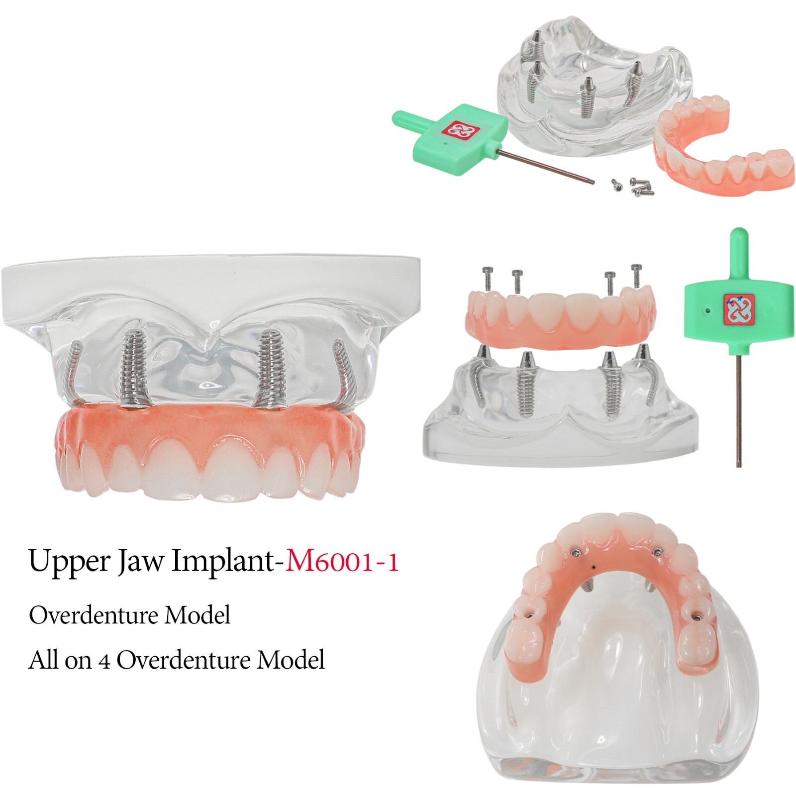 Dental All-on-4/6 Overdenture lmplant Restoration Model Upper/Lower Jaw Clear