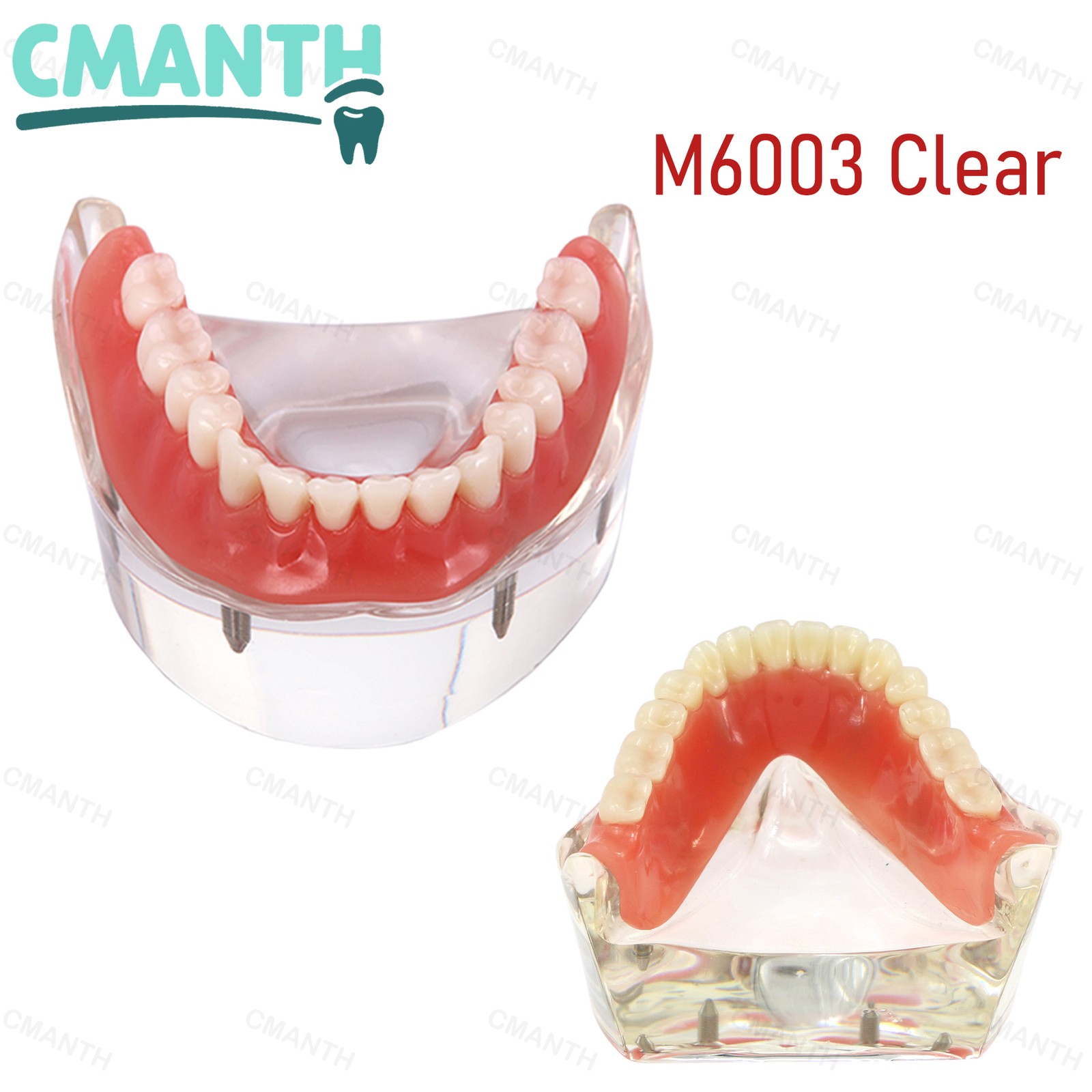US Dental Model Clear Upper Lower 4 Implants Overdenture Restoration Removable