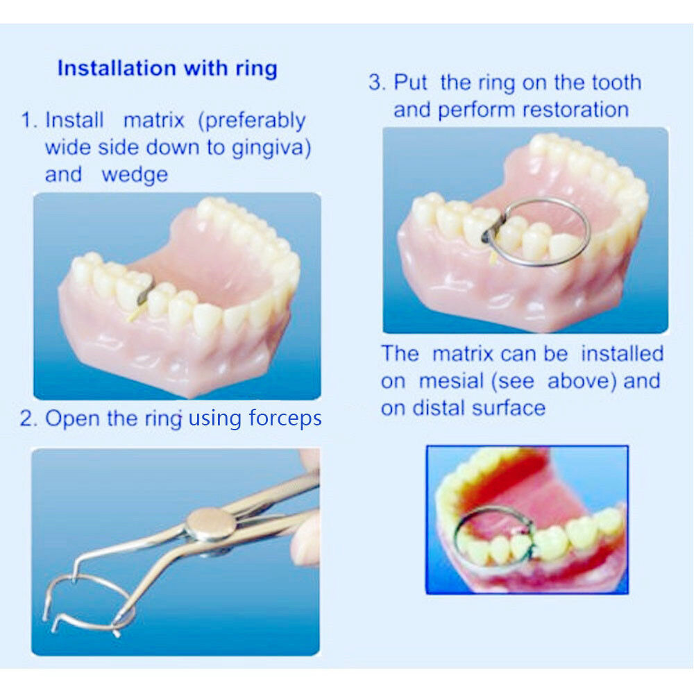 Dental Contoured Matrices Matrix Full Matrix Kit 35μm Hard No.1.398 + 2 Rings
