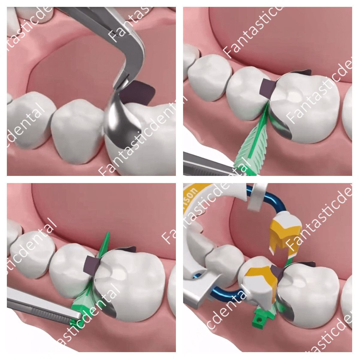 Dental Matrix Ring Clamp Endo Strata Wedges 3D Composite Kits Fits Garrison