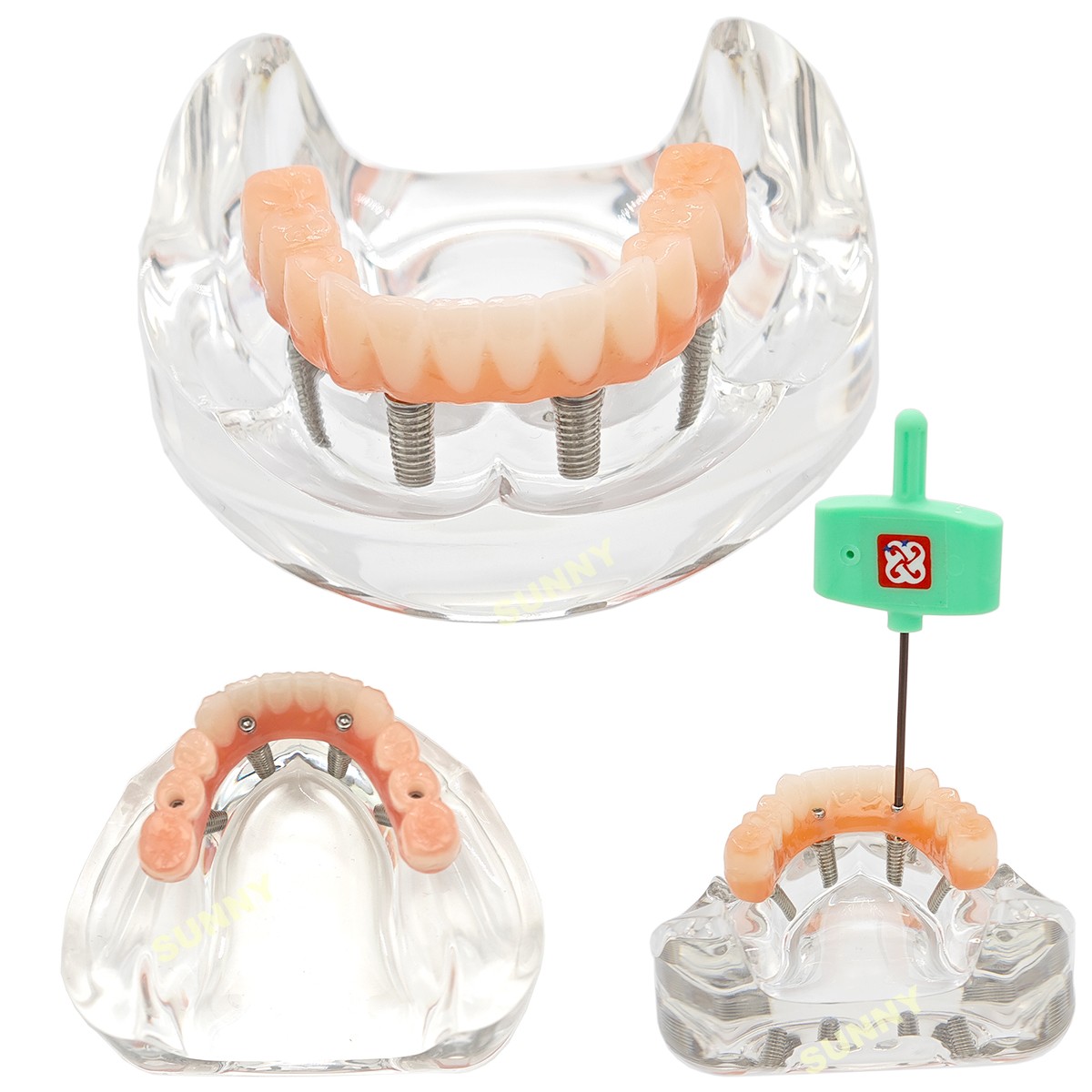 US Dental Implants Teeth Model Upper Lower Jaw 4/6 Overdenture Practice Demo