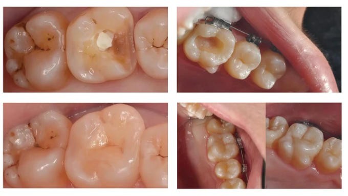 C14 Emax Glass Ceramic Without Sintering CAD/CAM Cerec Block Instant Restoration