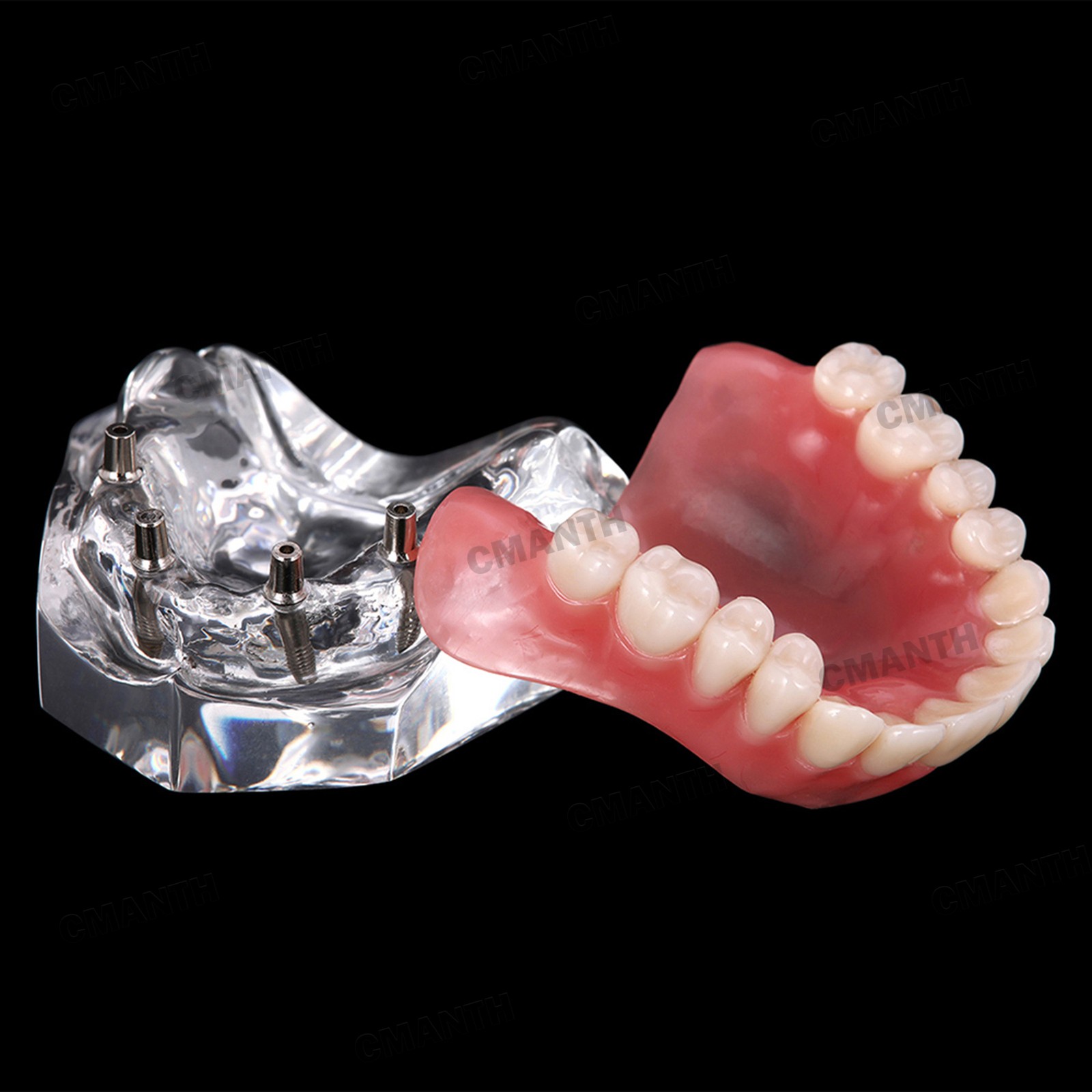 US Dental Model Removable Overdenture Teeth Upper/Lower Jaw 4 Implants Model