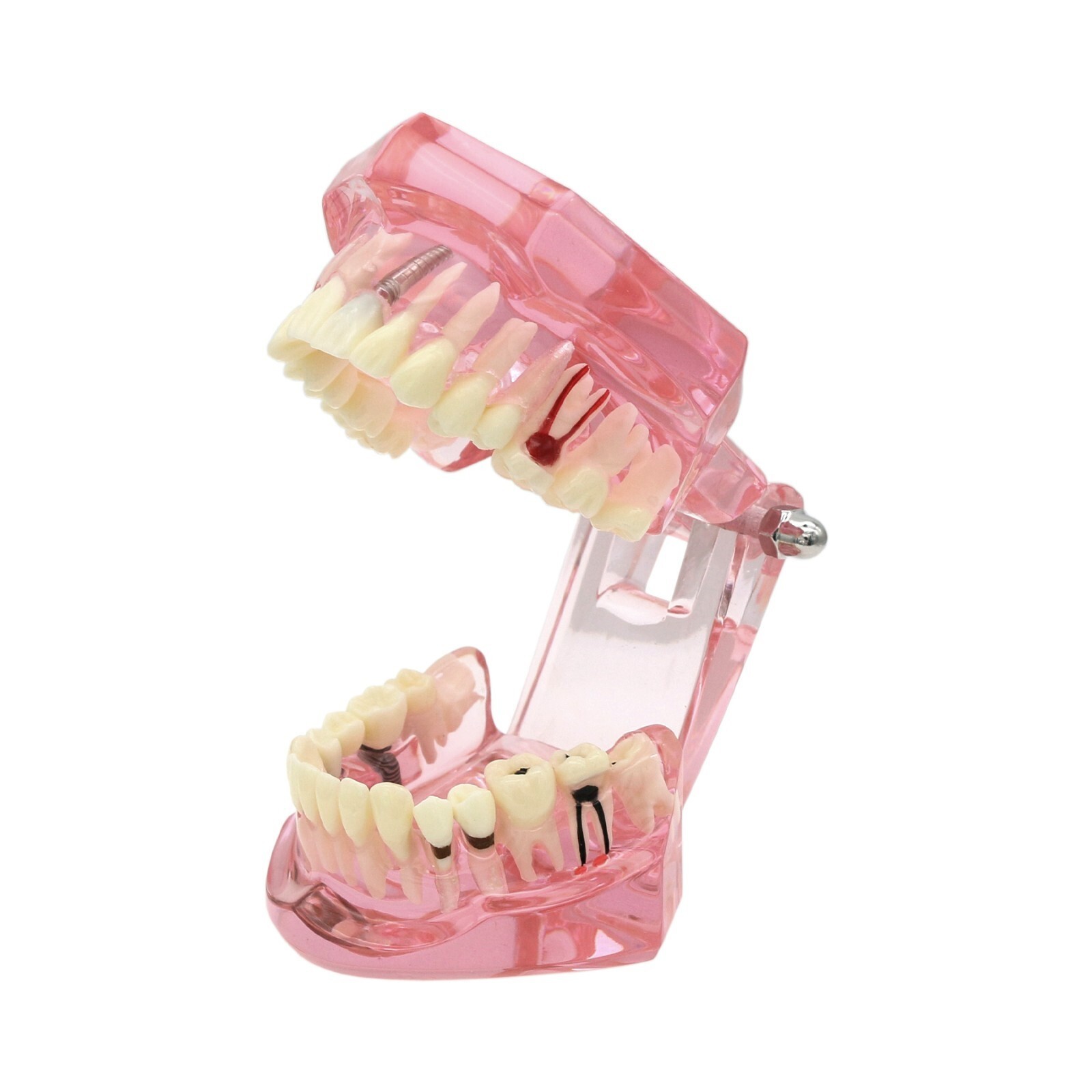 Dental Implant Teeth Model Teach Study Demo Restoration Pathology #2001 Pink