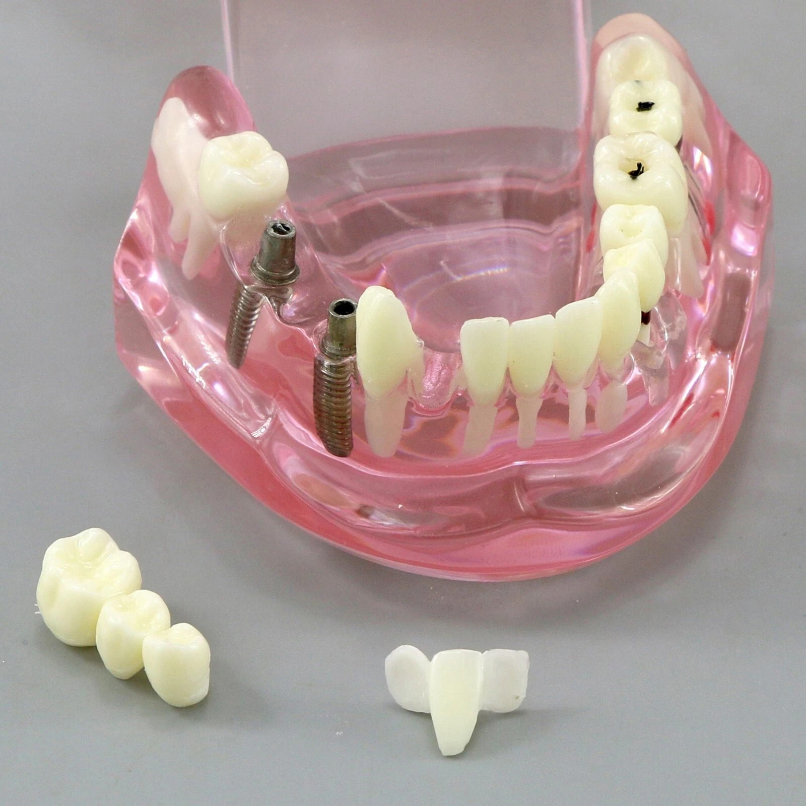 Dental Implant Teeth Model Teach Study Demo Restoration Pathology #2001 Pink
