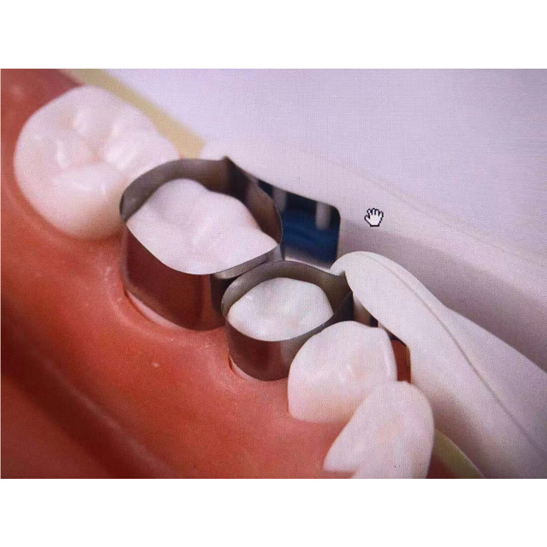 Ortho IPR Strip Dental Interproximal Reduction Kit enamel Strip+Pro Matrix Bands