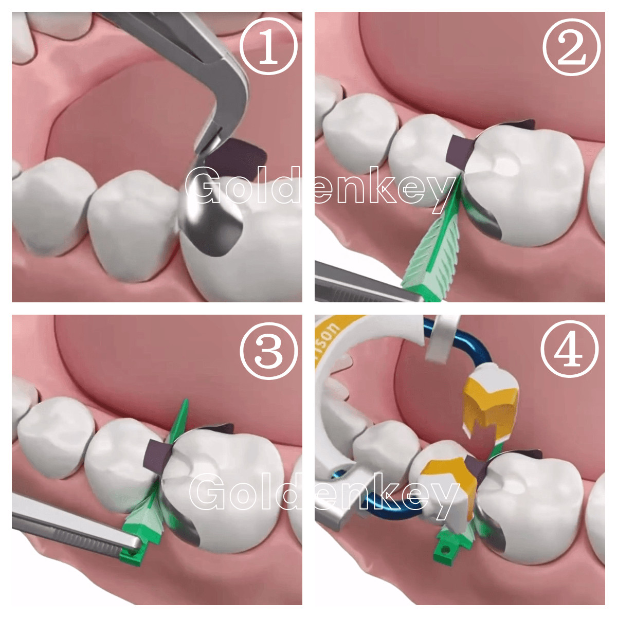 Dental Soft Strata G Wedges Cervical Seal Diastema Composite Matrix Garrison US