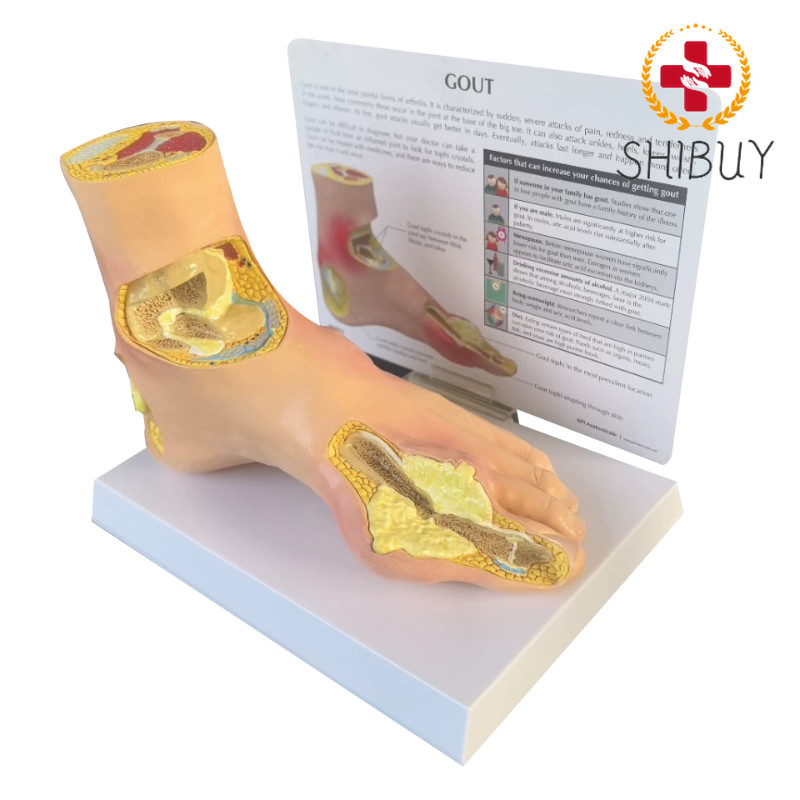 Diabetes Target Organ Model Pain Wind Stone Foot Complication Model