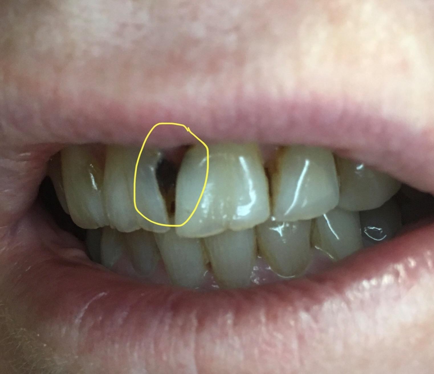 Quick Relief Dental Repair Solution | Temparin Max 2-Pack for Fillings & Caps