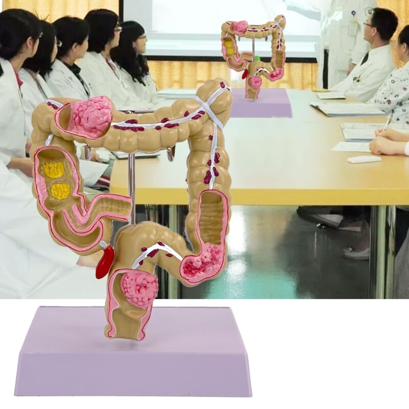 Human Large Intestine Model Teaching Model Medicals Supplies for School Study