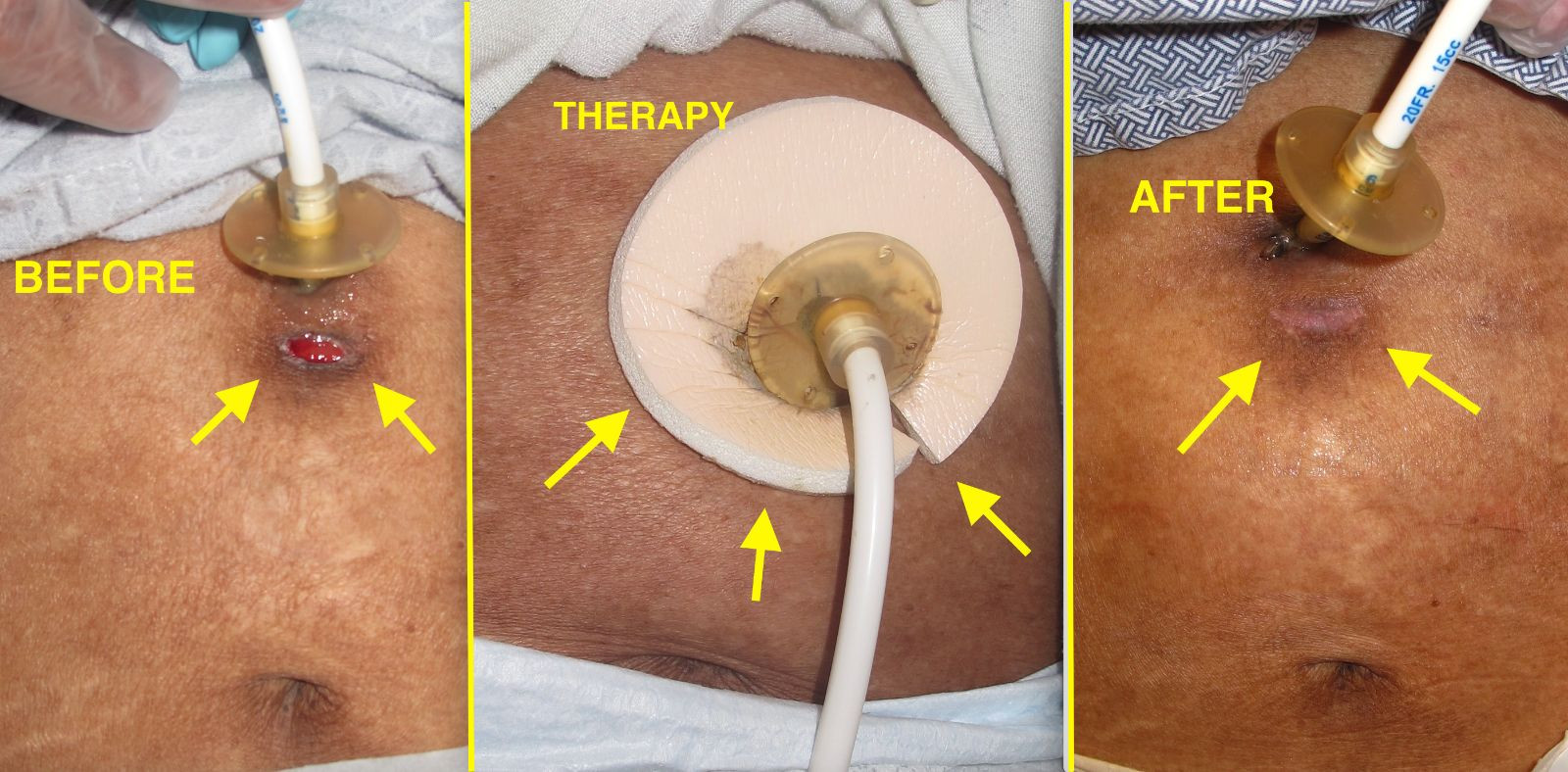 ROUND Silicone Foam wound Dressing – for Tube site & PEG – Absorbs Leakage