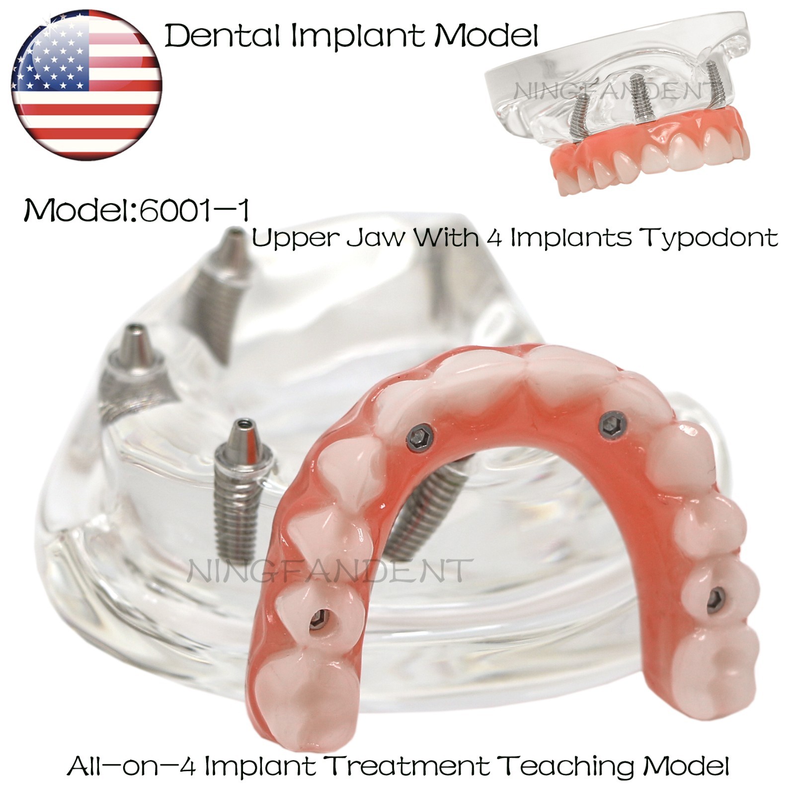 USAll on 4 Dental Implant Model Overdenture Upper Jaw 4 Implant Clear Detachable