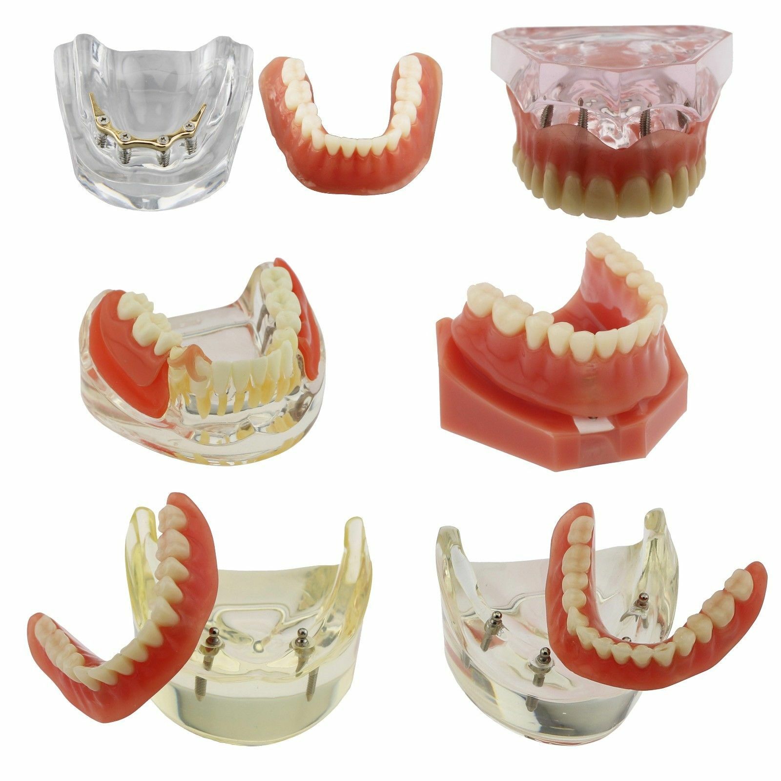 Dental Implants Restoration Model Overdenture Inferior With Demo Teaching Study
