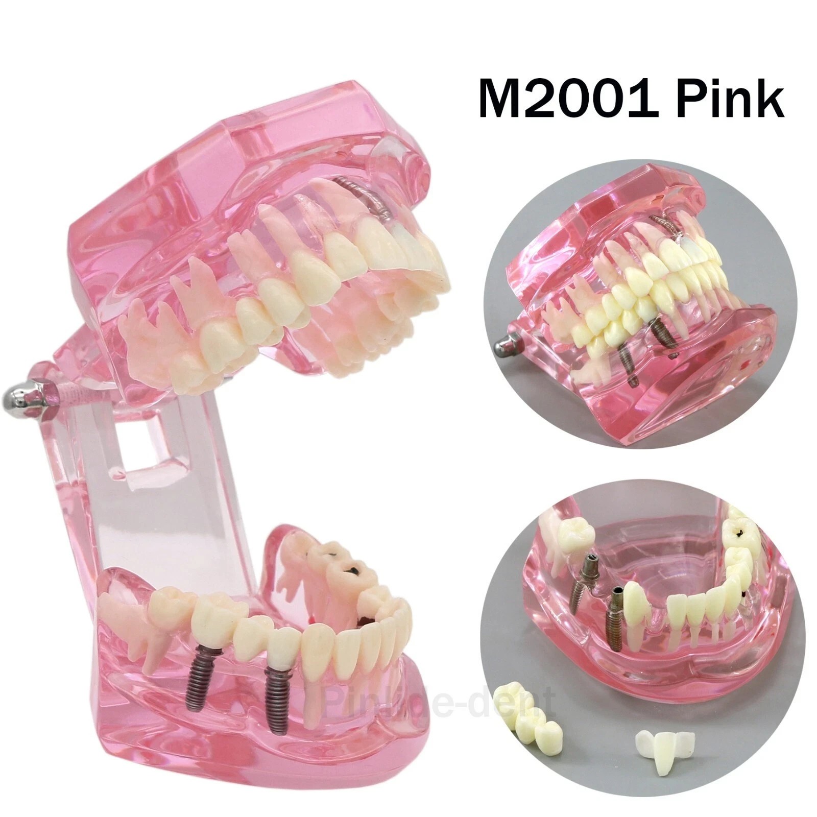 Dental Implant Teeth Model Teach Study Demo Restoration Pathology #2001 Pink