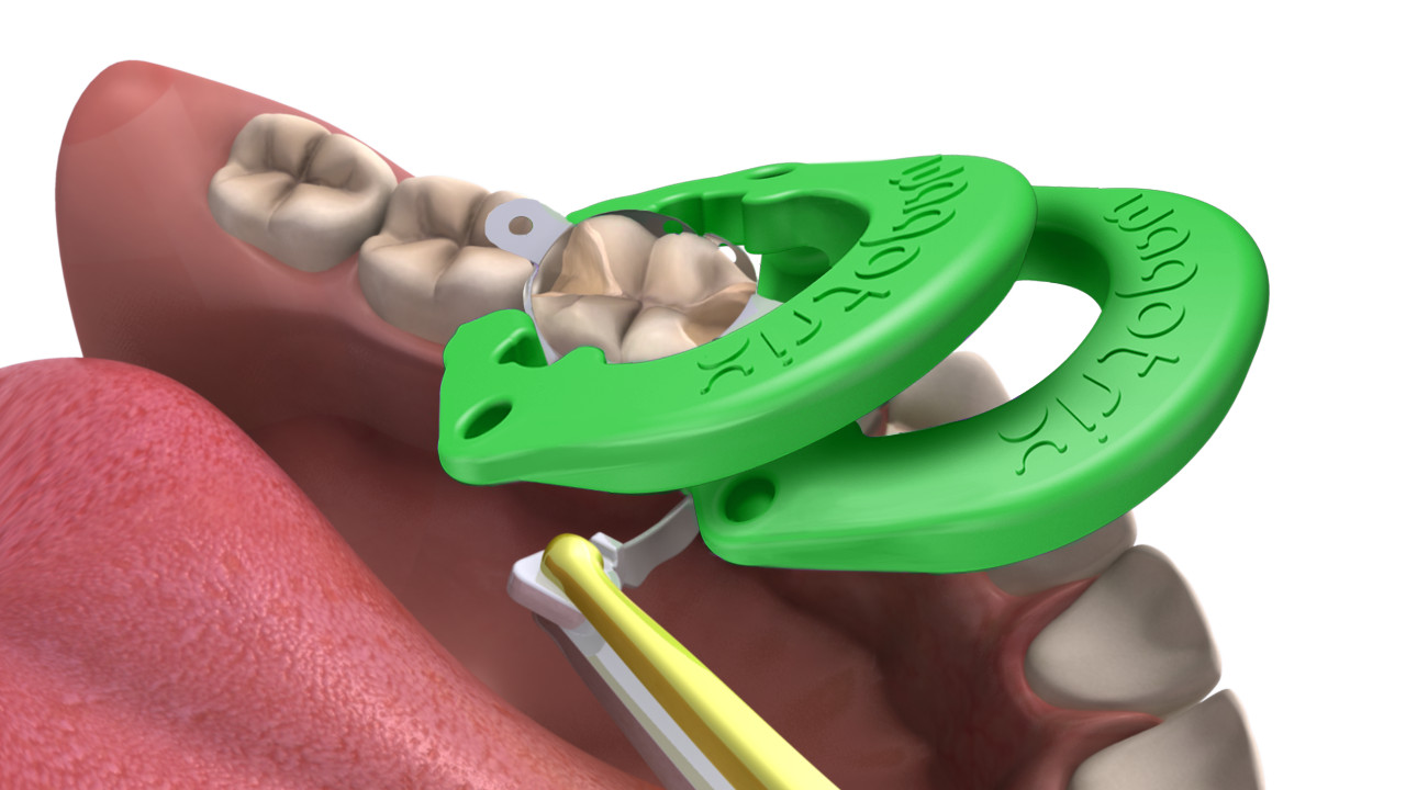 Sectional Matrix System, Dental Rings – Wagotrix Universal Matrix Rings – Qty 35