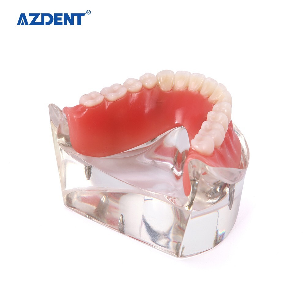 Dental Demonstration 4 Implants Teeth Model Typodont Inferior Overdenture Lower