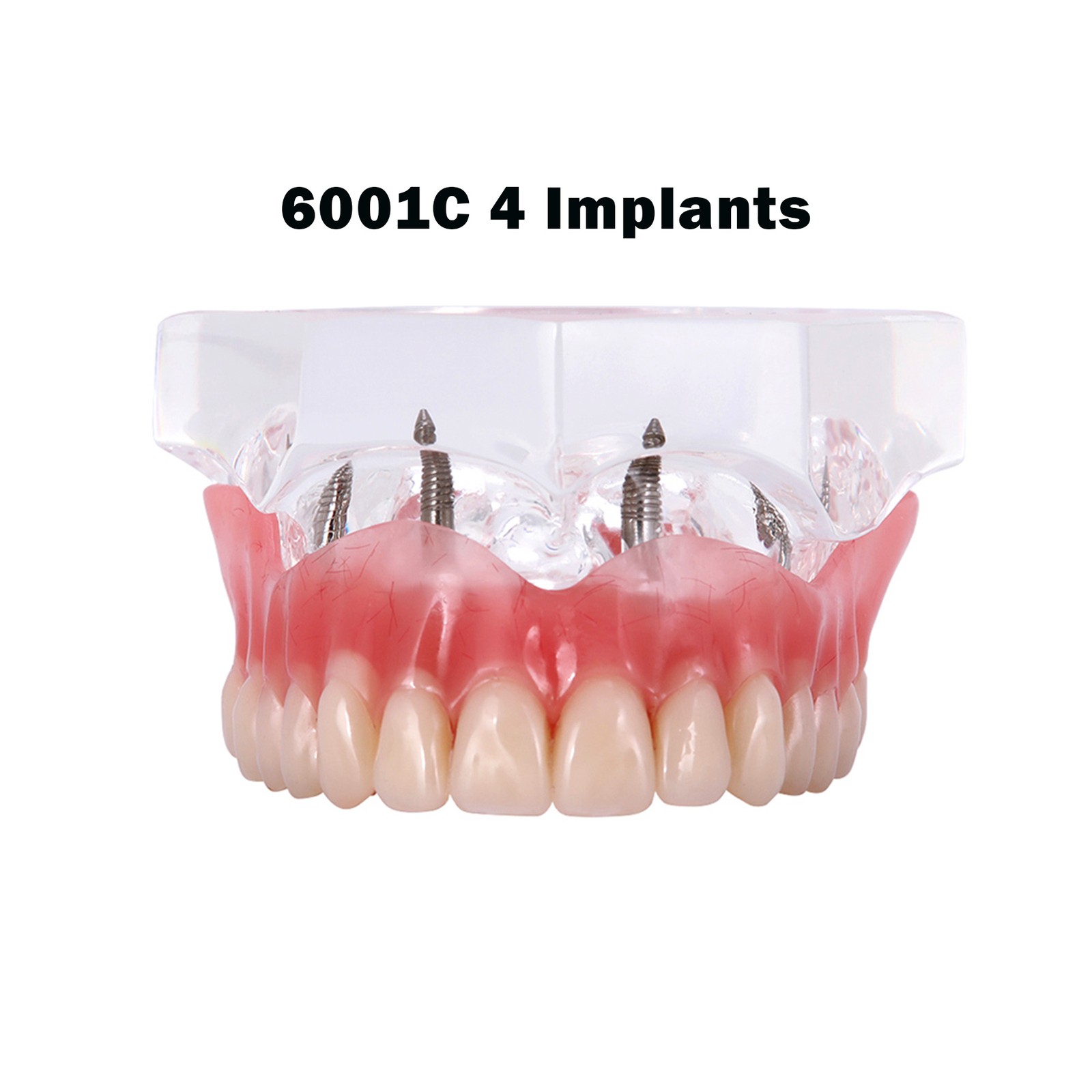 US Dental Model Clear Upper Lower 4 Implants Overdenture Restoration Removable