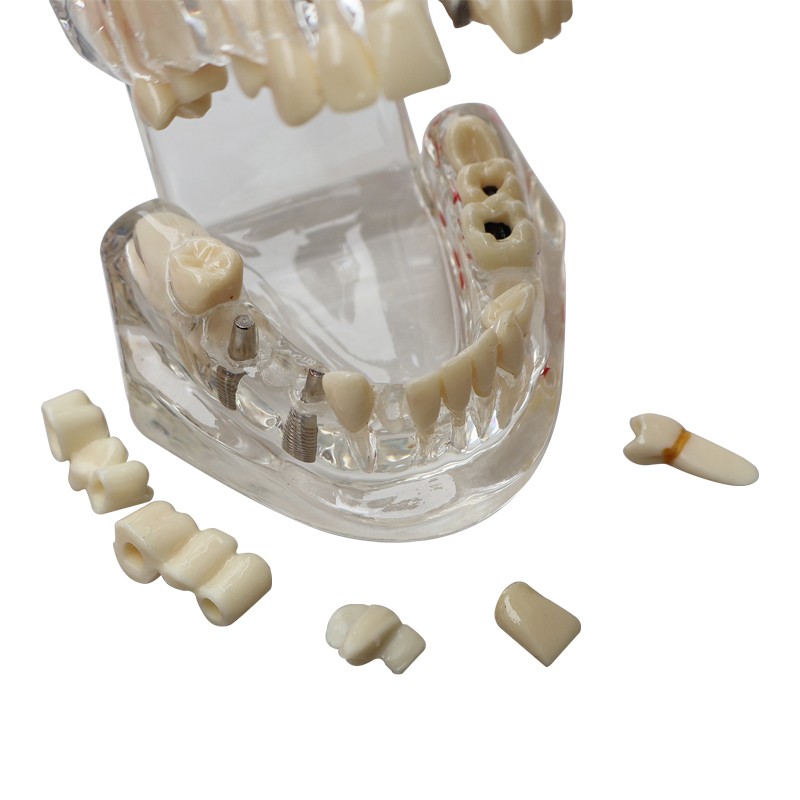Dental Teeth Model Ortho Implant Practice Teaching With Implants Demo Model