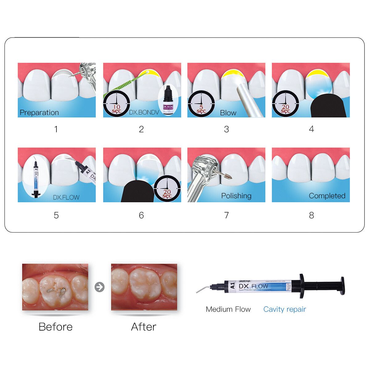 Dental Dentex A1 Medium Flow Flowable Light Cure Composite Resin Syringe