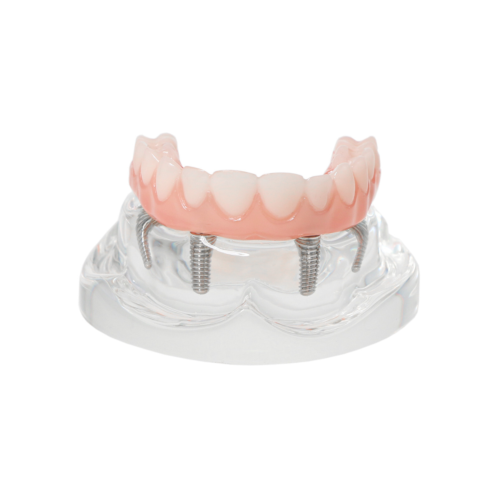 Dental 4 Implants Upper&Lower Demo Implant Teeth Model Restoration Overdenture