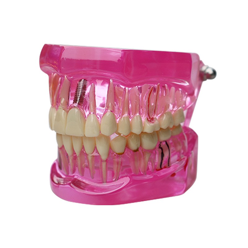Dental Teeth Model Ortho Implant Practice Teaching With Implants Demo Model