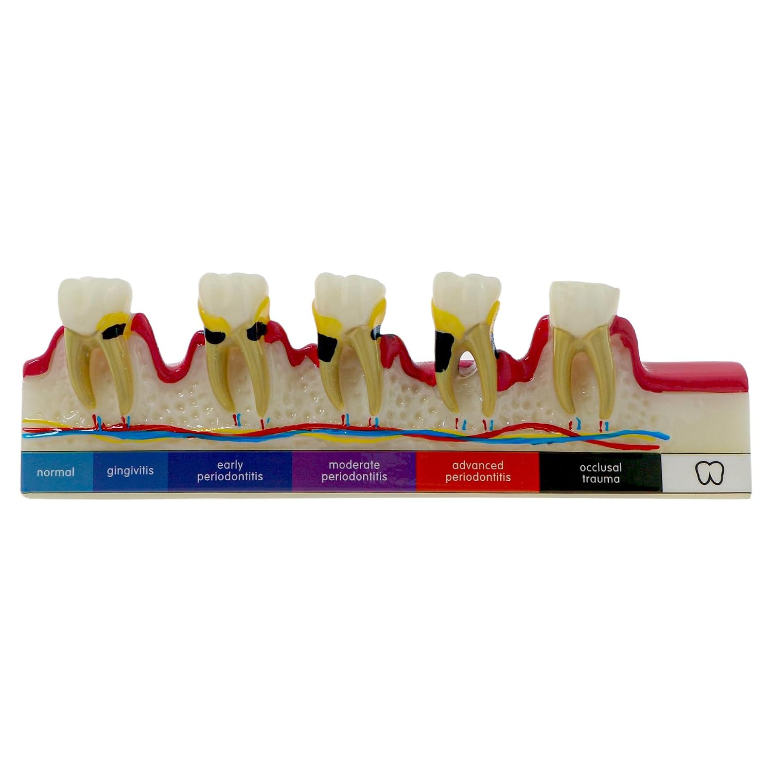 Dental Model 6-Stage Periodontal Disease Demonstration Model | Normal to Advance