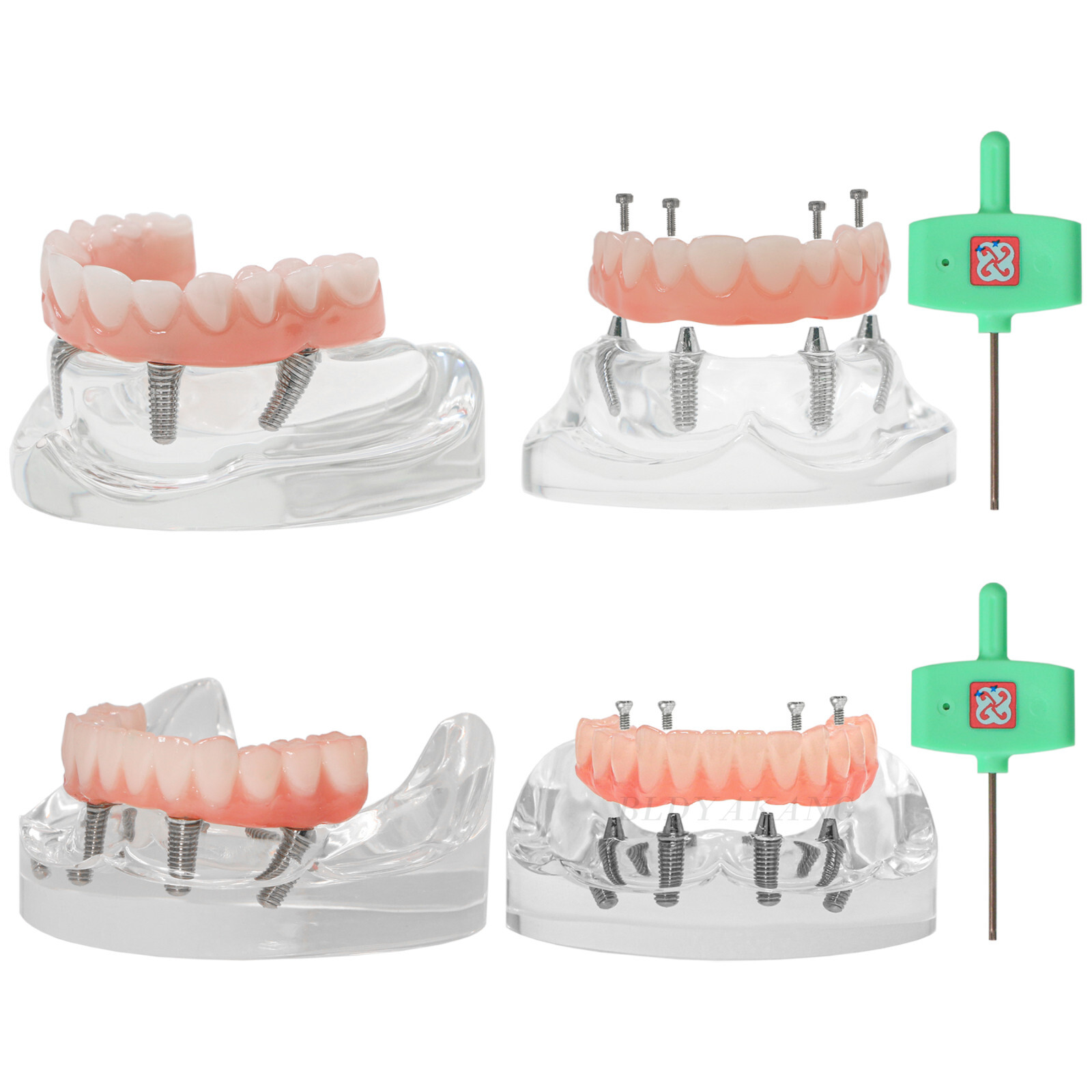 US Dental 4 Screws Overdenture Model All on 4 Restoration Upper/Lower Jaw Type