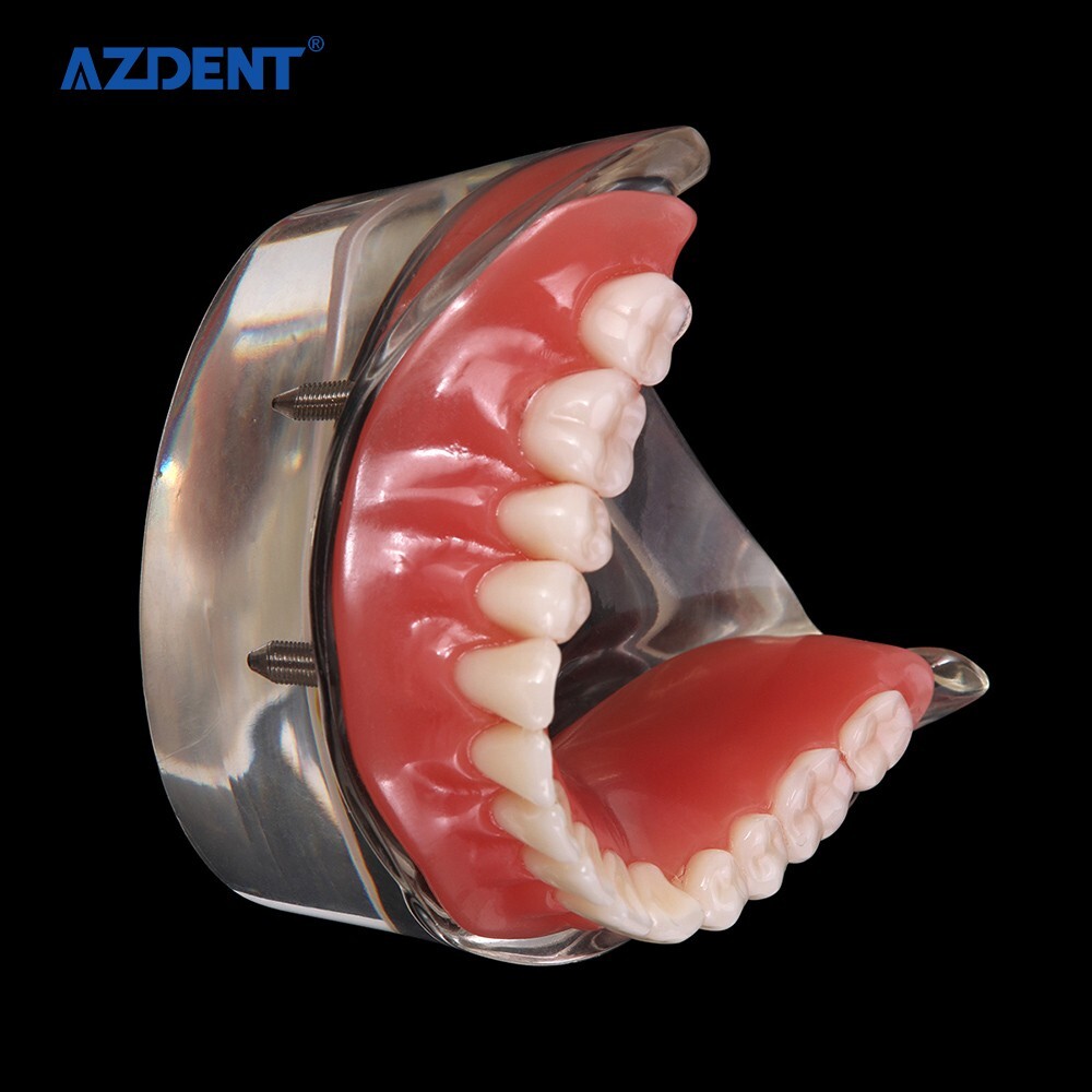 Dental Demonstration 4 Implants Teeth Model Typodont Inferior Overdenture Lower
