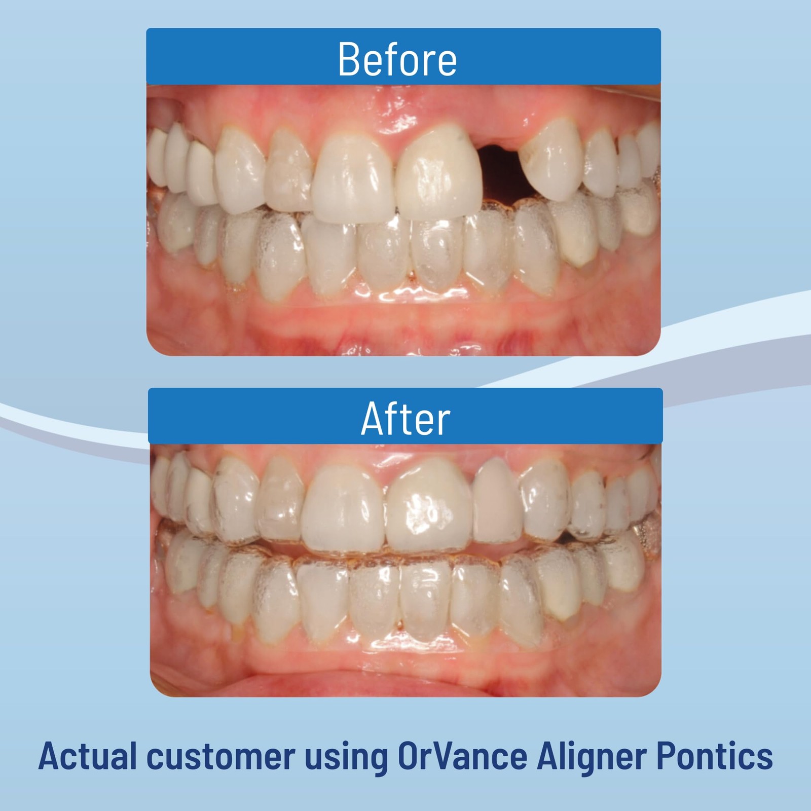 OrVance Aligner Pontics – Original 16 Count (Pack of 1), Medium Shade