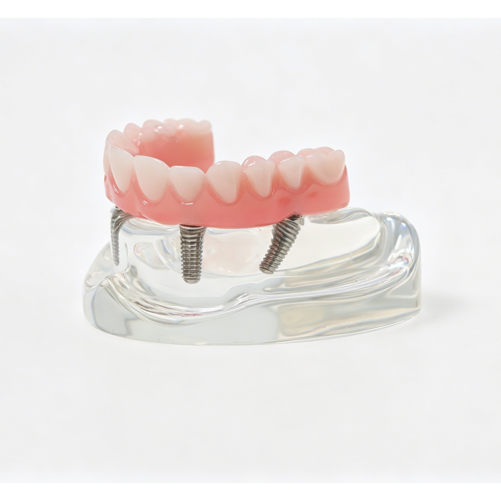 USAll on 4 Dental Implant Model Overdenture Upper Jaw 4 Implant Clear Detachable