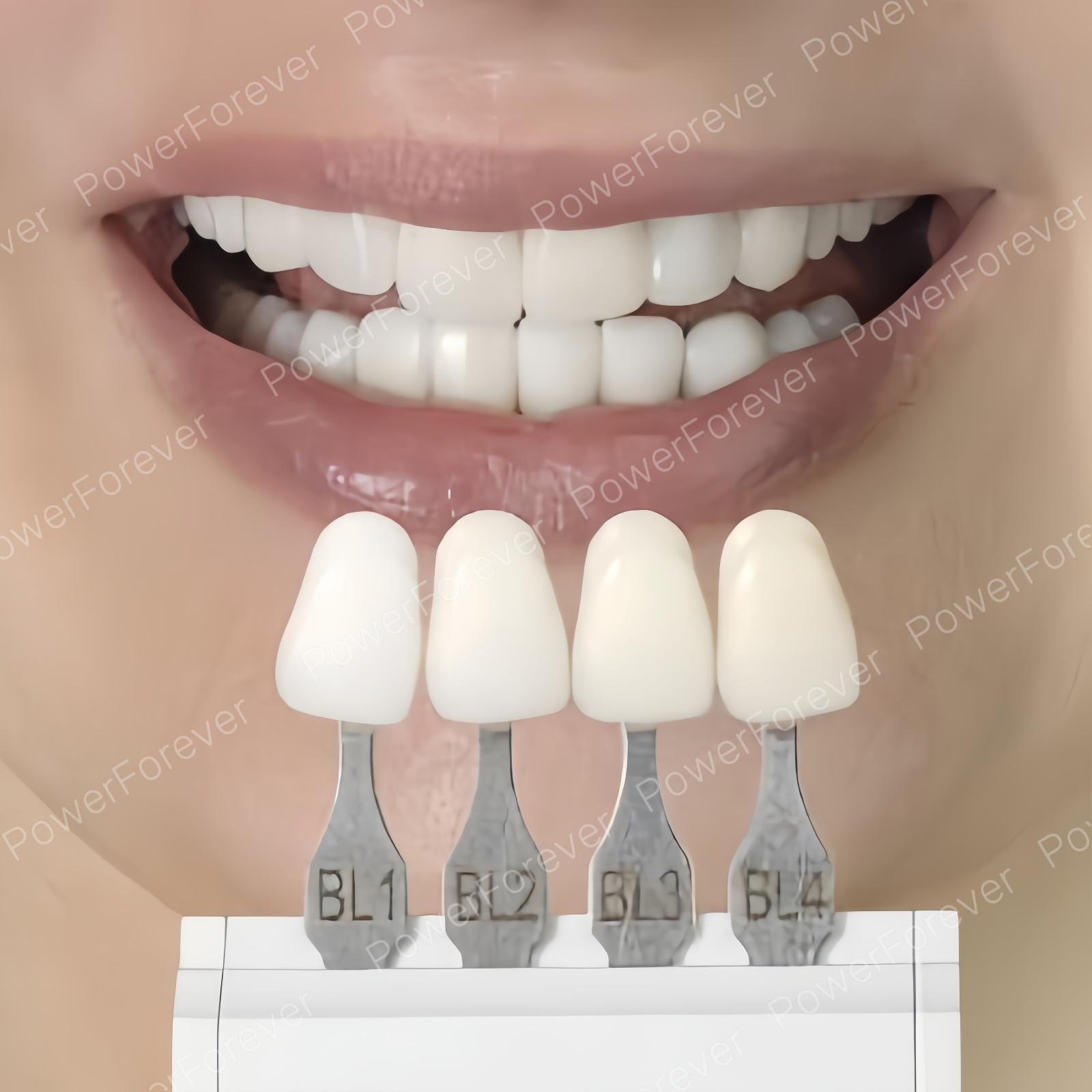 5Pcs Dental Delivery Tips Flow Composite Resin Conveyor Flowable Tip Z350 XT