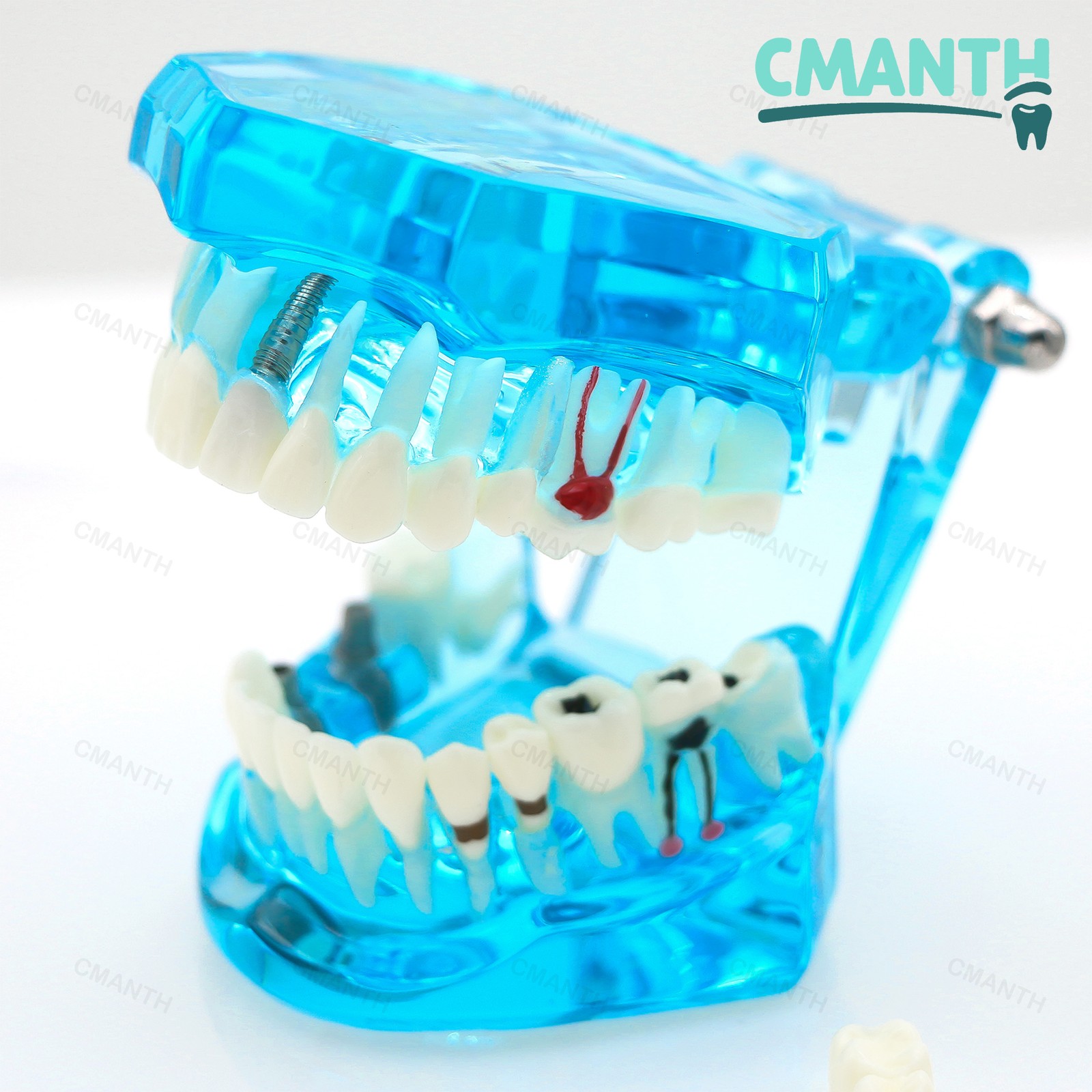 Dental Model Bridge Restoration Pathology Study Demo Teaching Model M2001