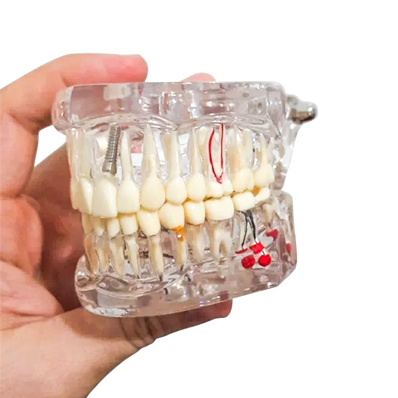 Dental Disease Teeth Model Tooth Demonstration Model for Dental Research Study