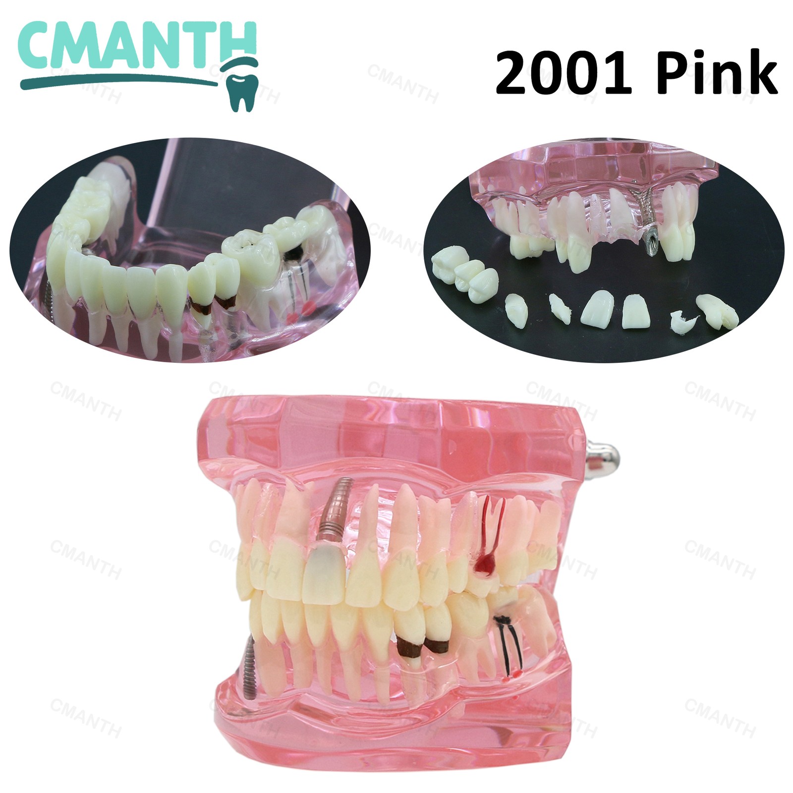 US Dental lmplant Teeth Model Bridge Restoration Pathology Study Demo M2001
