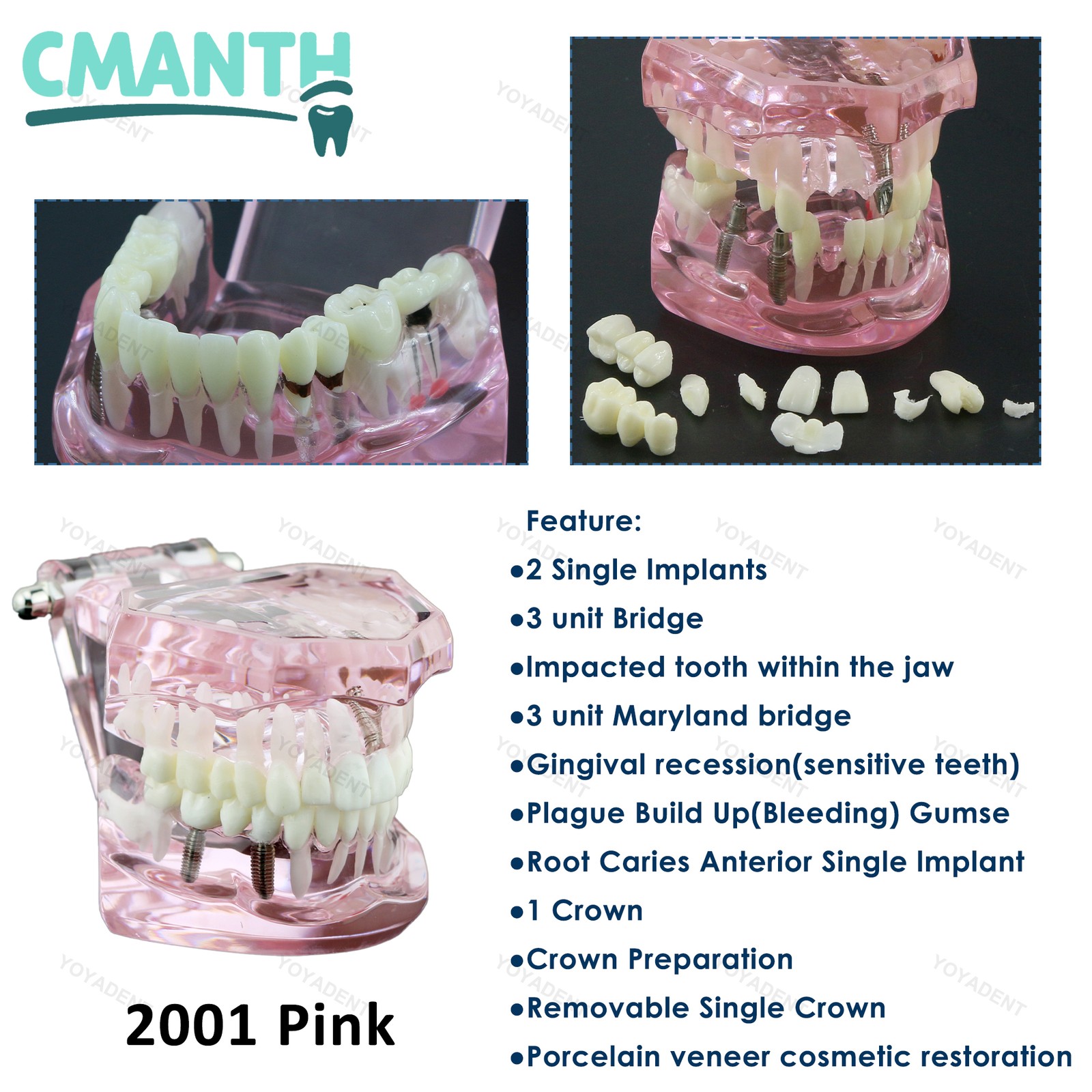 Dental Model Bridge Restoration Pathology Study Demo Teaching Model M2001